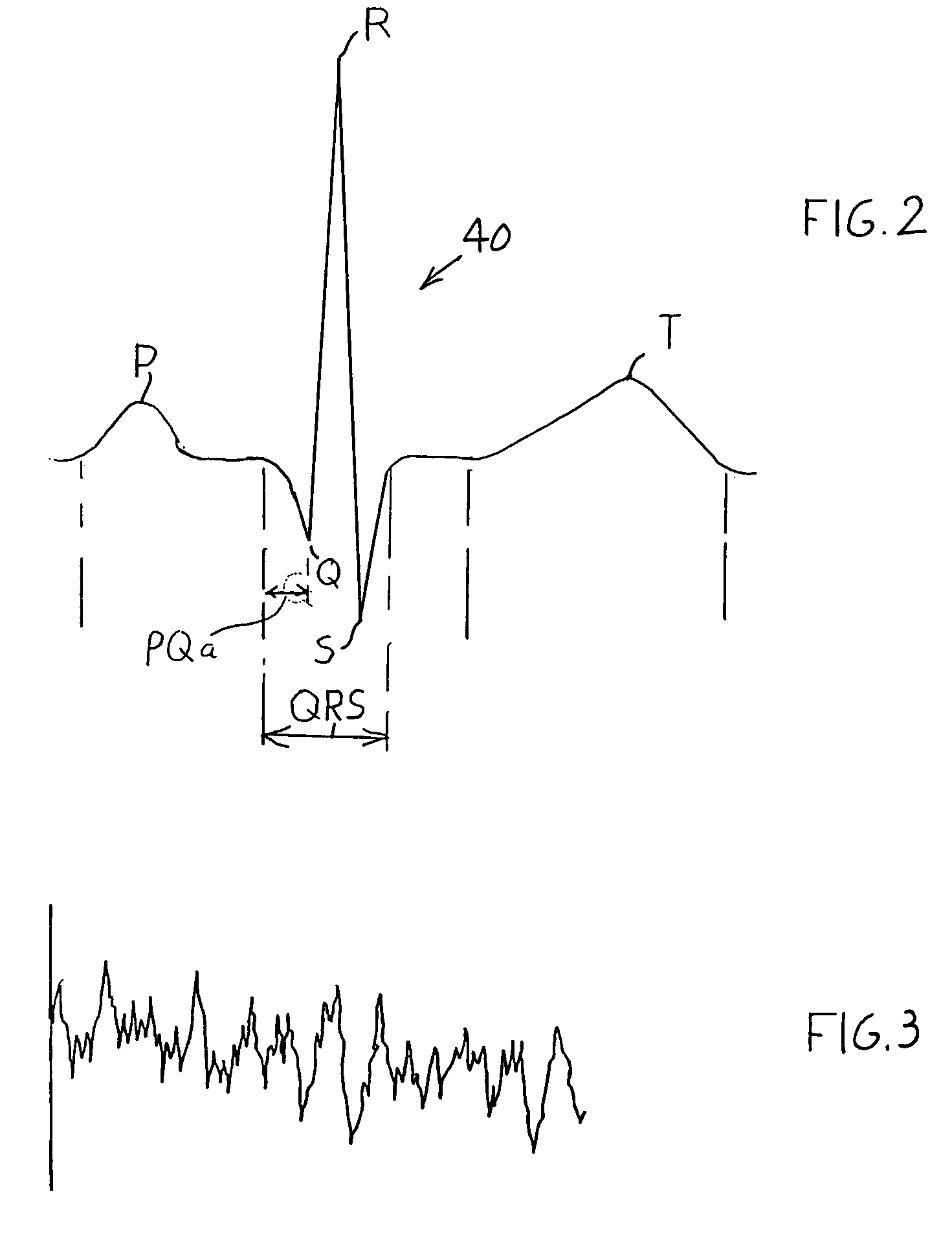 Rhythm identification in compression corrupted ECG signal