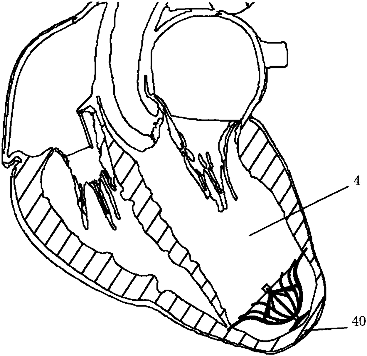 A left ventricular volume reduction device