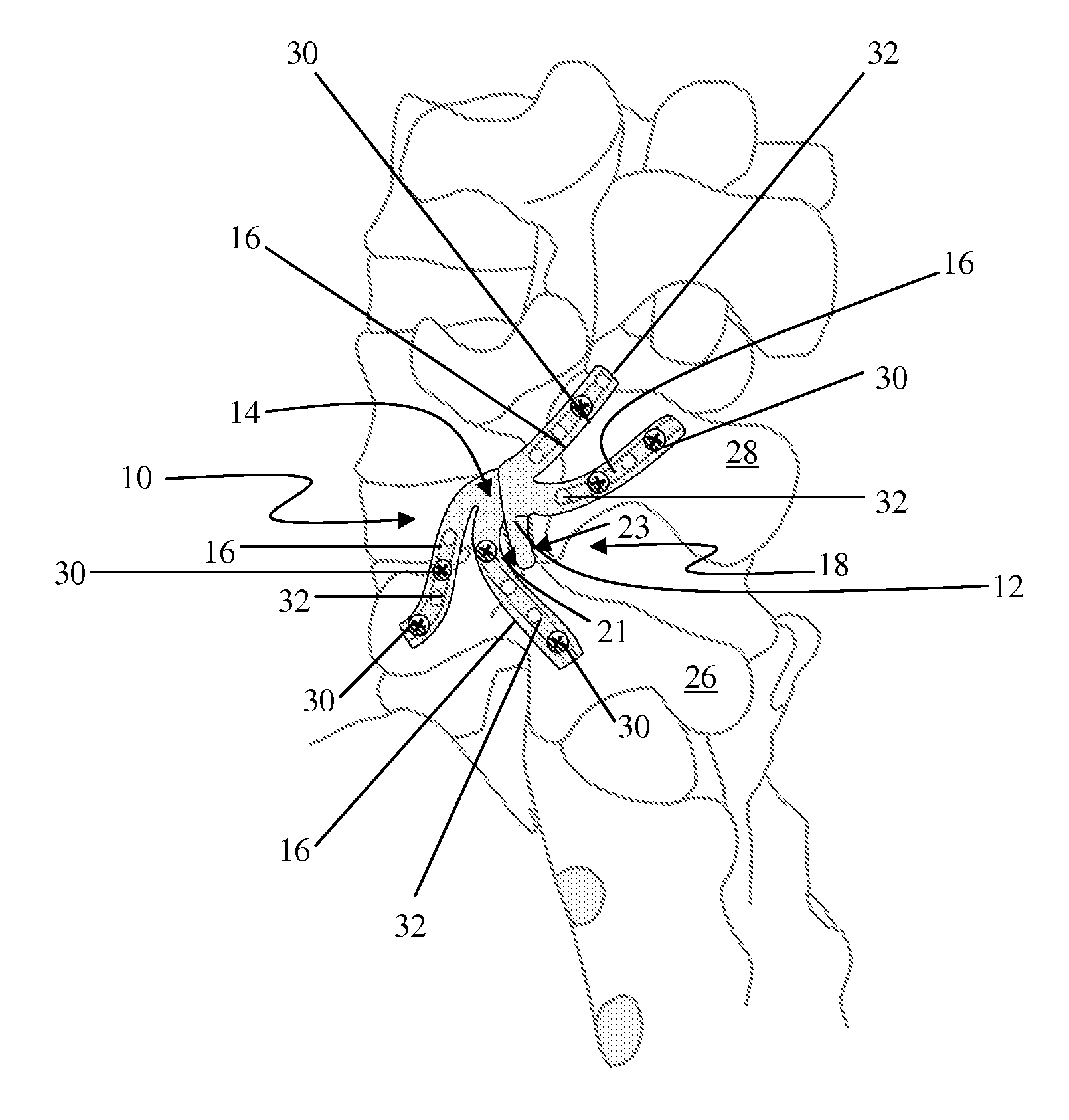 Facet Joint Implant and Related Methods