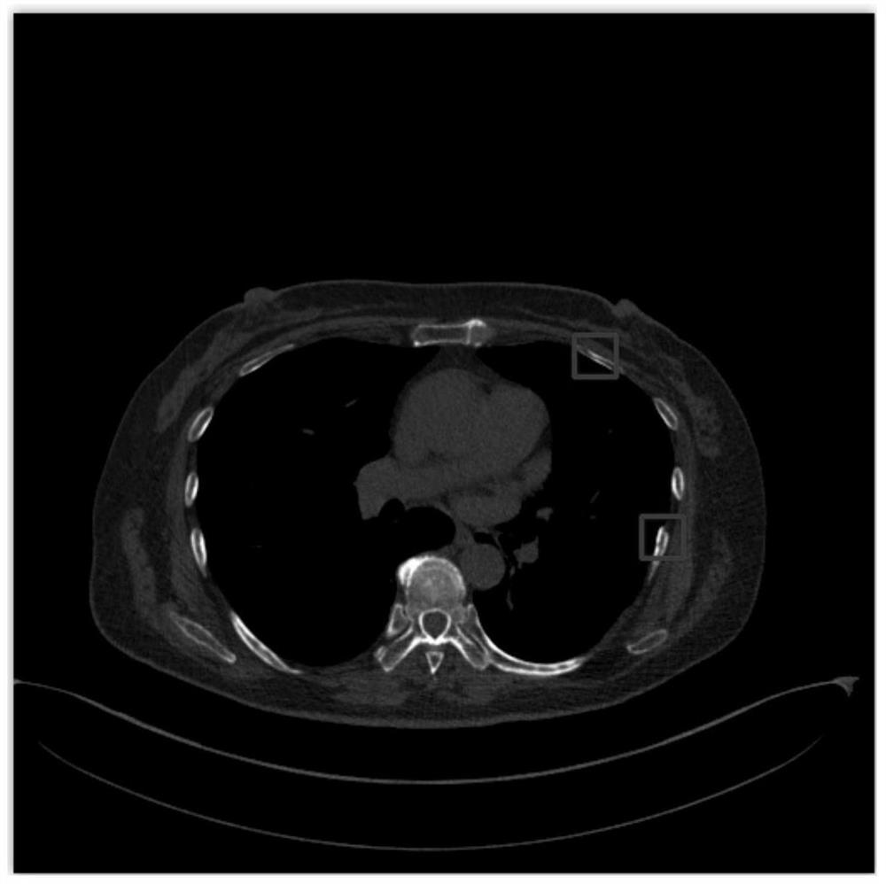 Rib small fracture detection method and system