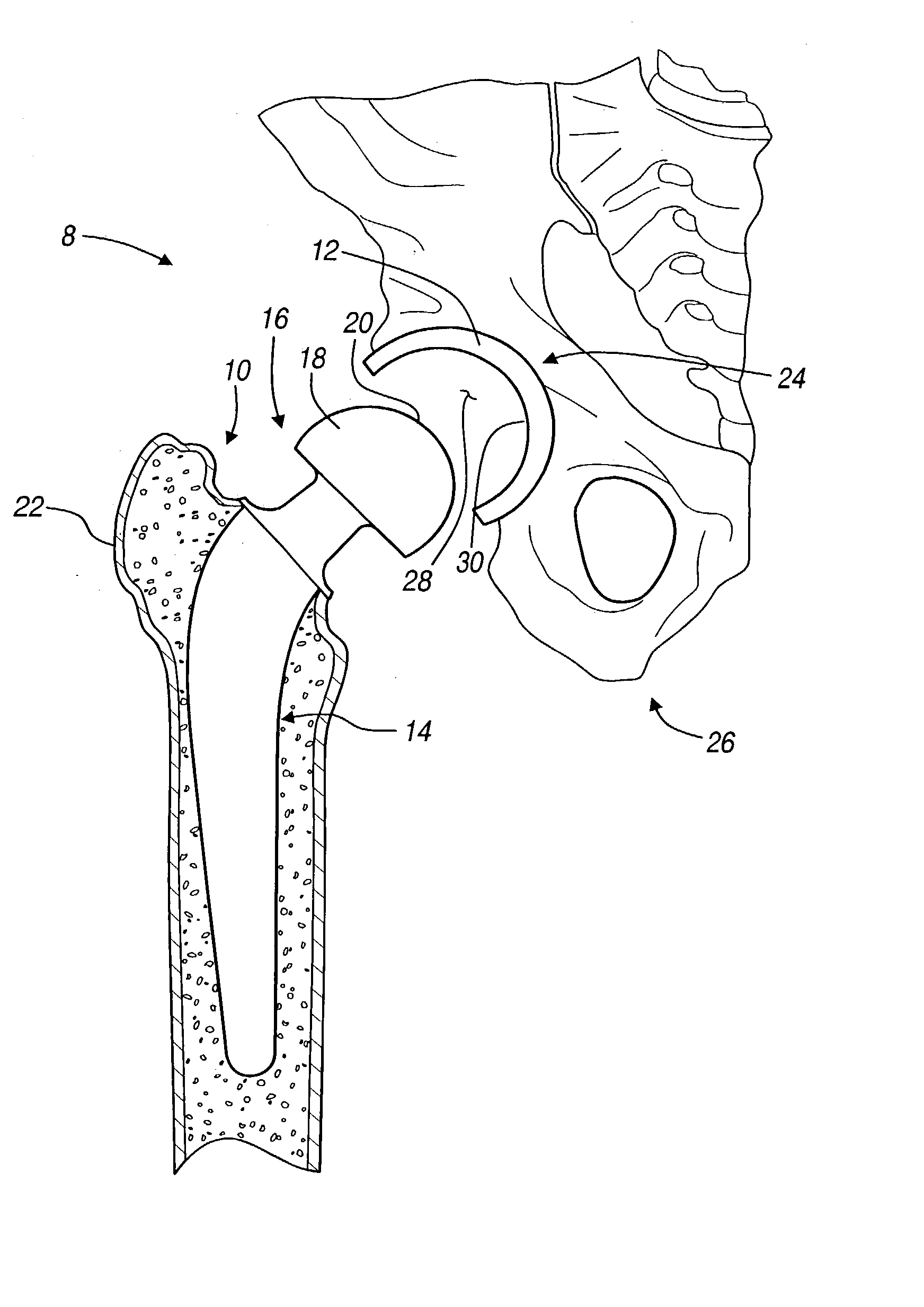 Wear surface for metal-on-metal articulation