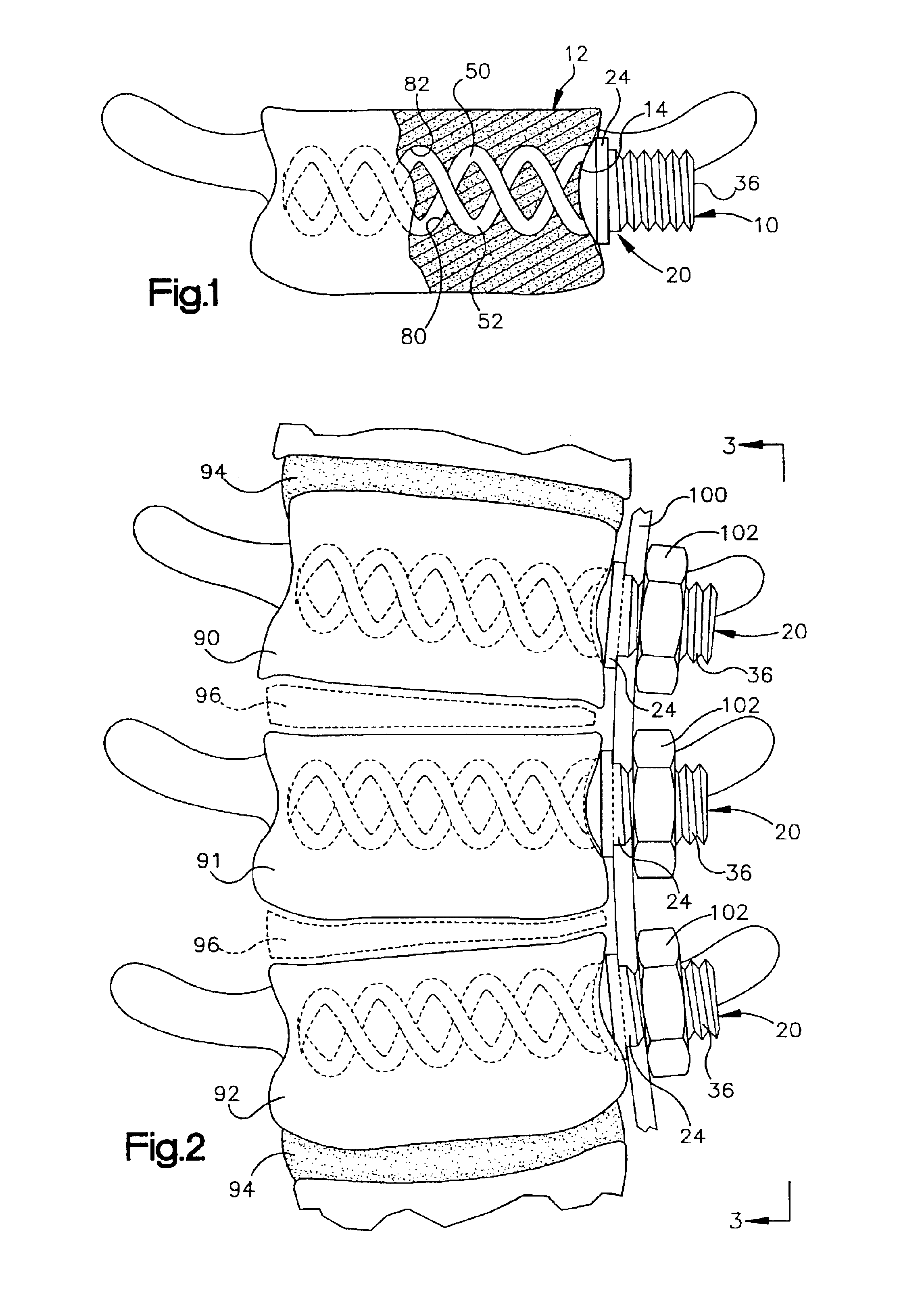 Apparatus for implantation into bone