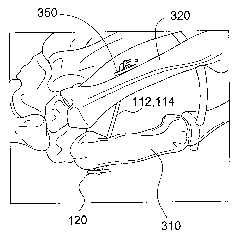 CMC repair using suture-button construct