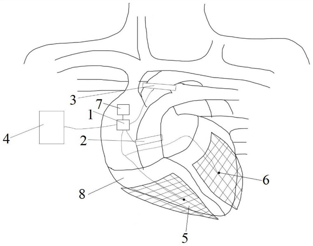 Anticoagulation-free heart auxiliary contraction device