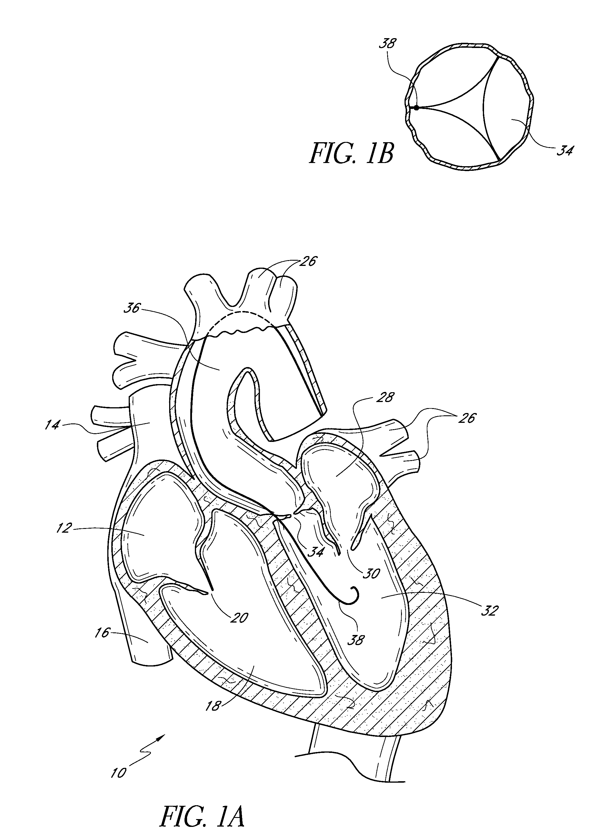 Catheter guidance through a calcified aortic valve