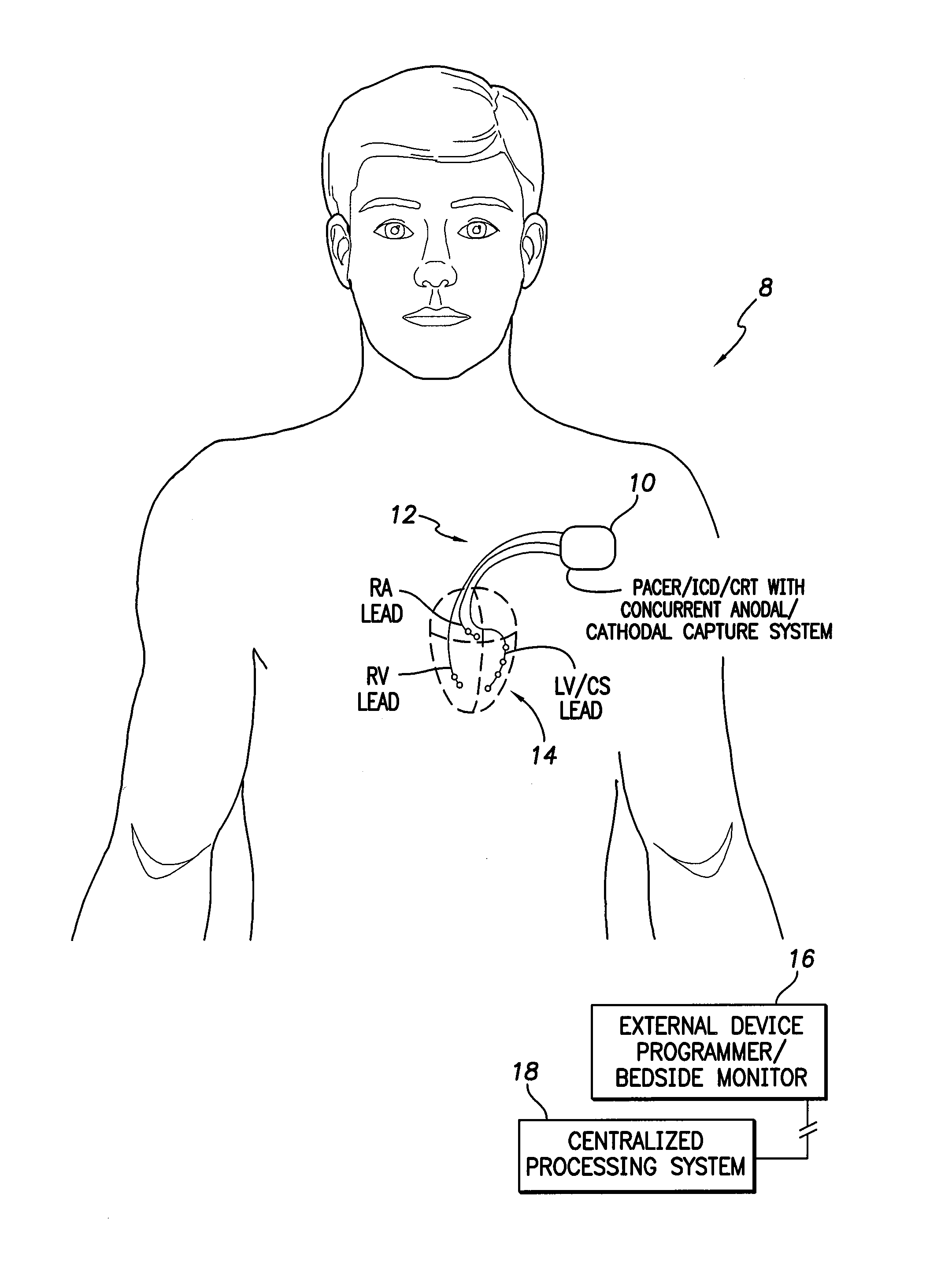 Systems and methods for assessing and exploiting concurrent cathodal and anodal capture using an implantable medical device