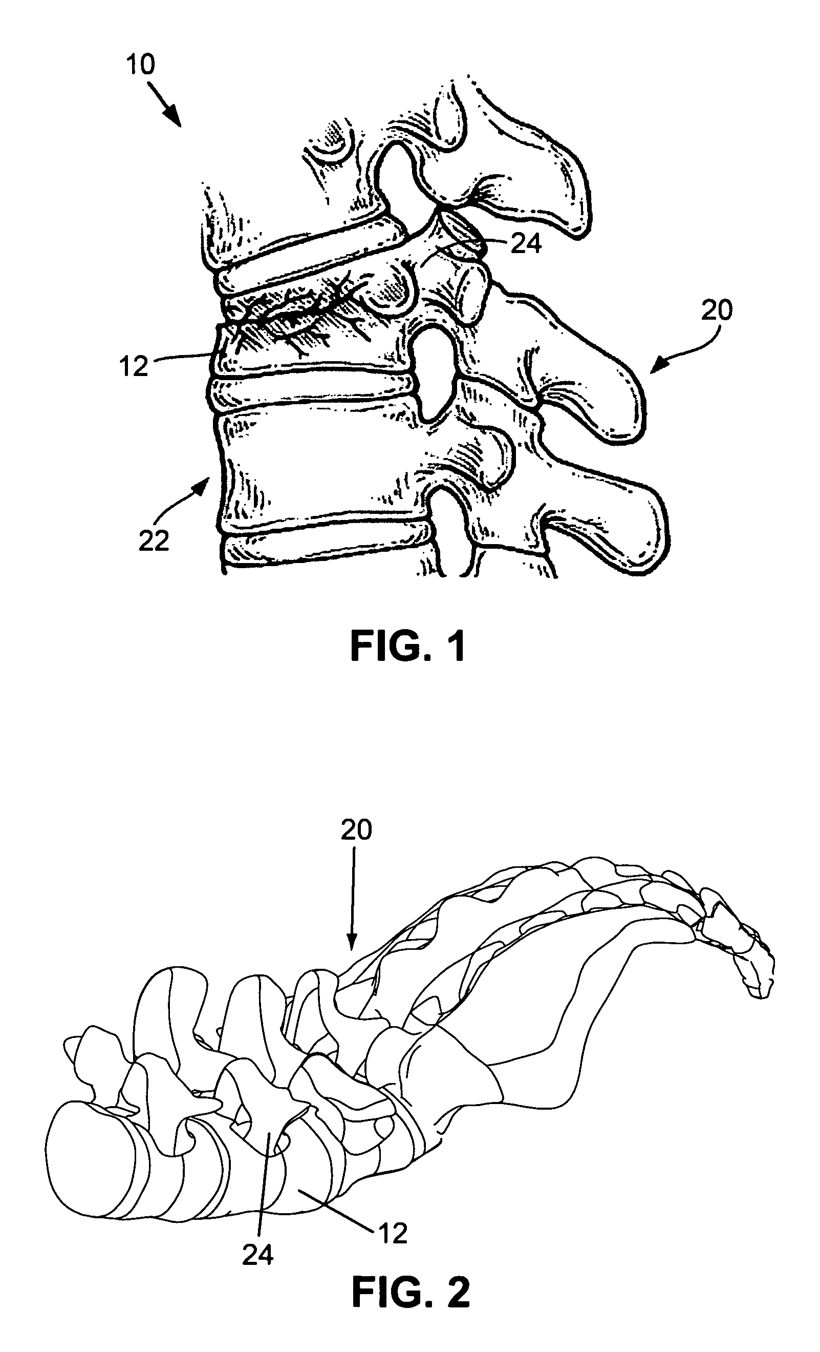 Apparatus and methods for vertebral augmentation