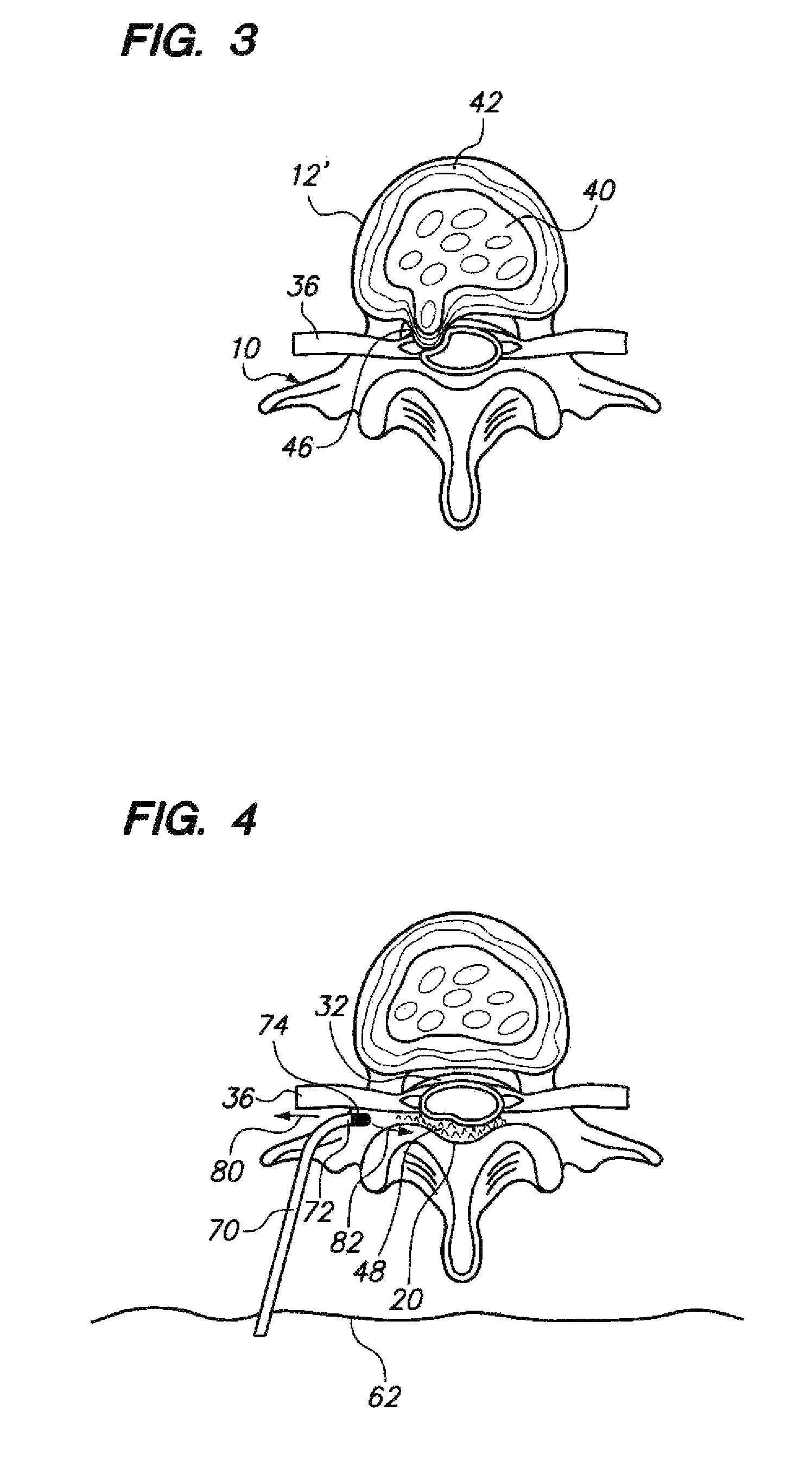 Slidable sheaths for tissue removal devices