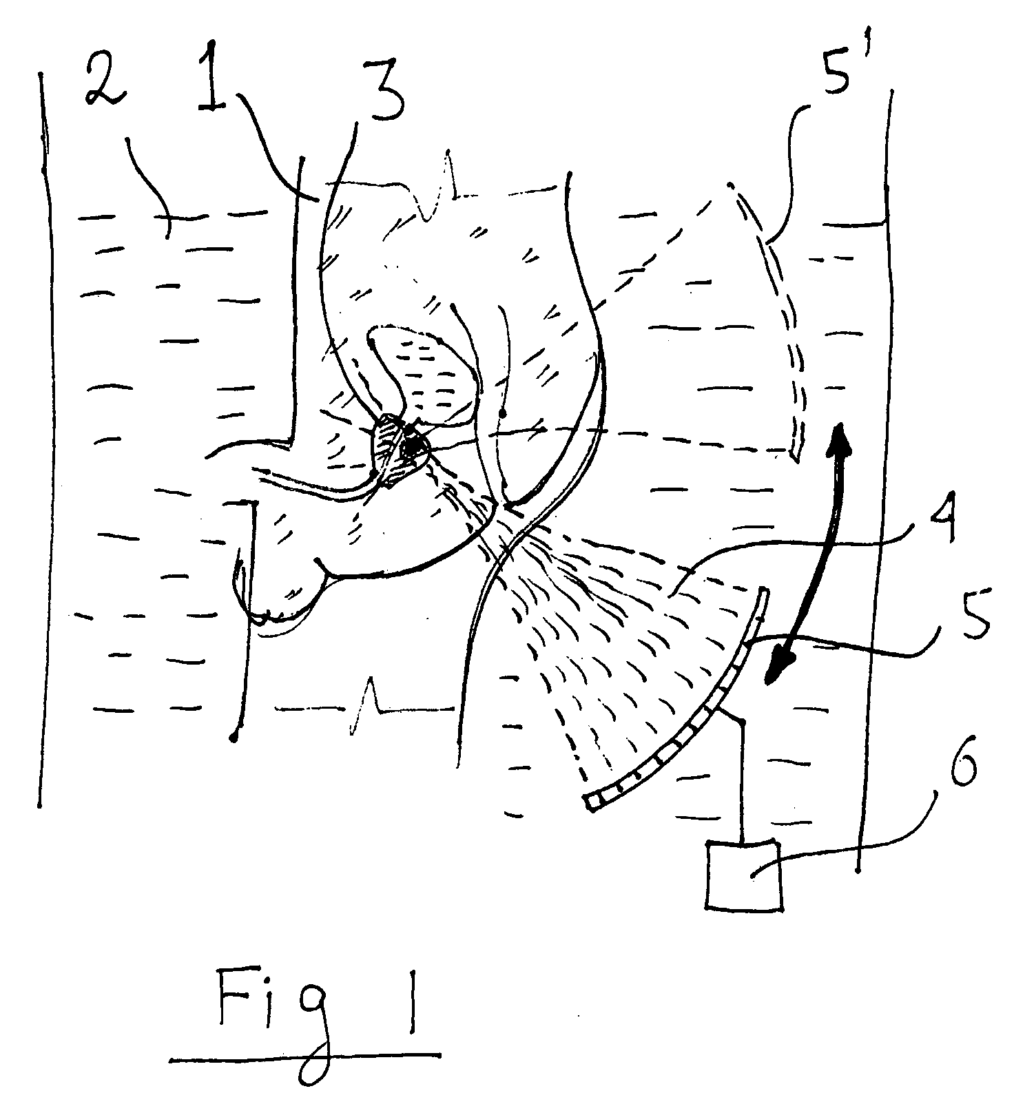 System for selective ultrasonic ablation