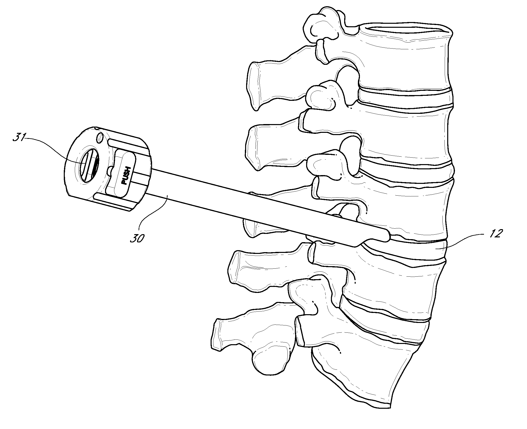 Method and apparatus for minimally invasive insertion of intervertebral implants