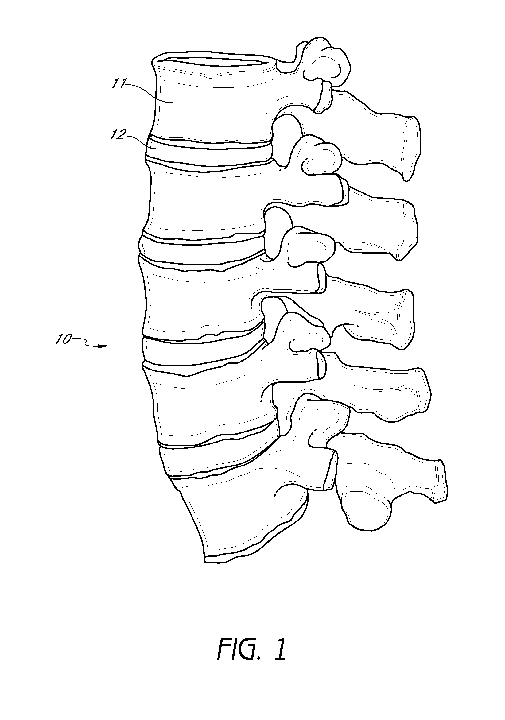 Method and apparatus for minimally invasive insertion of intervertebral implants