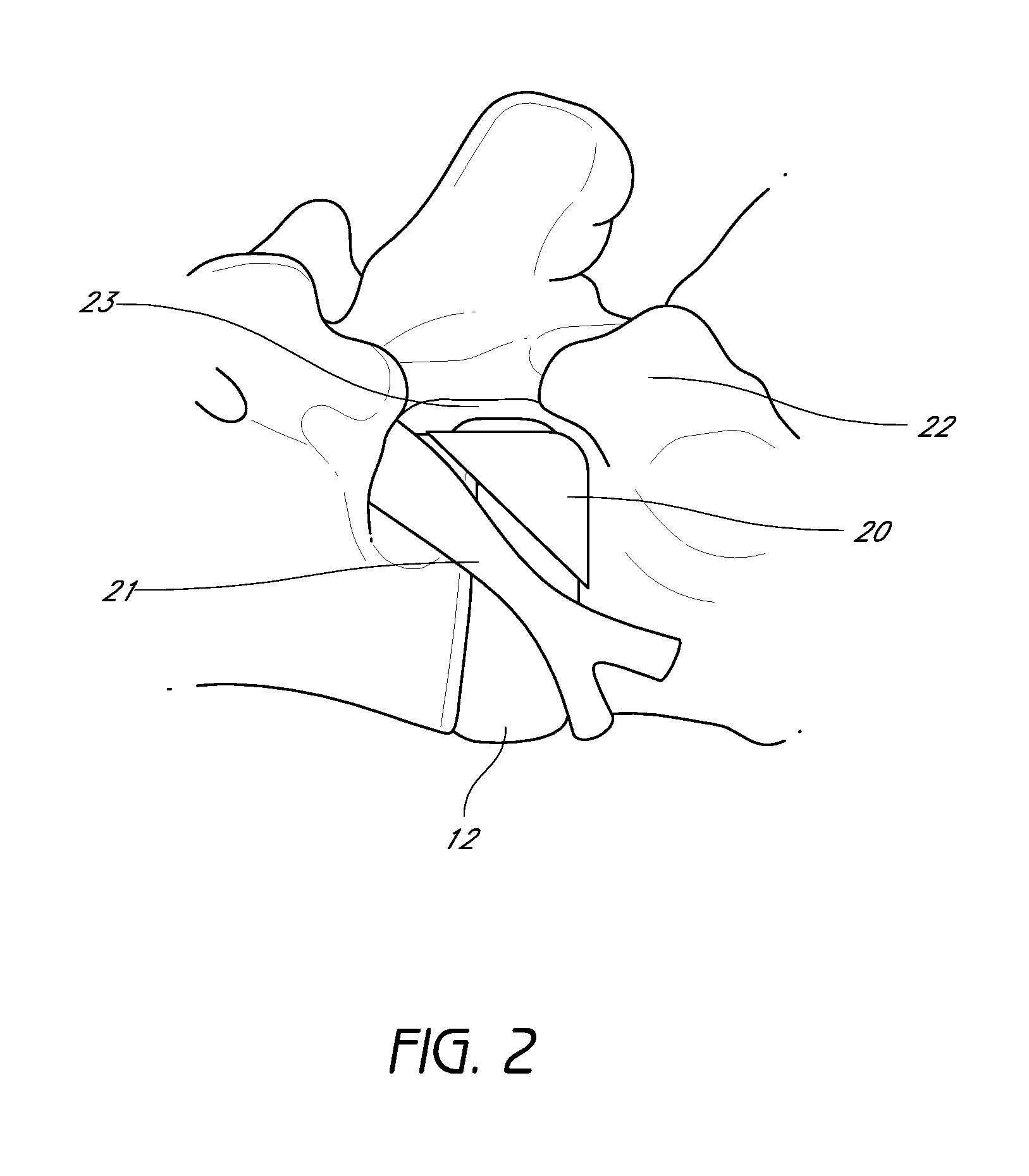 Method and apparatus for minimally invasive insertion of intervertebral implants