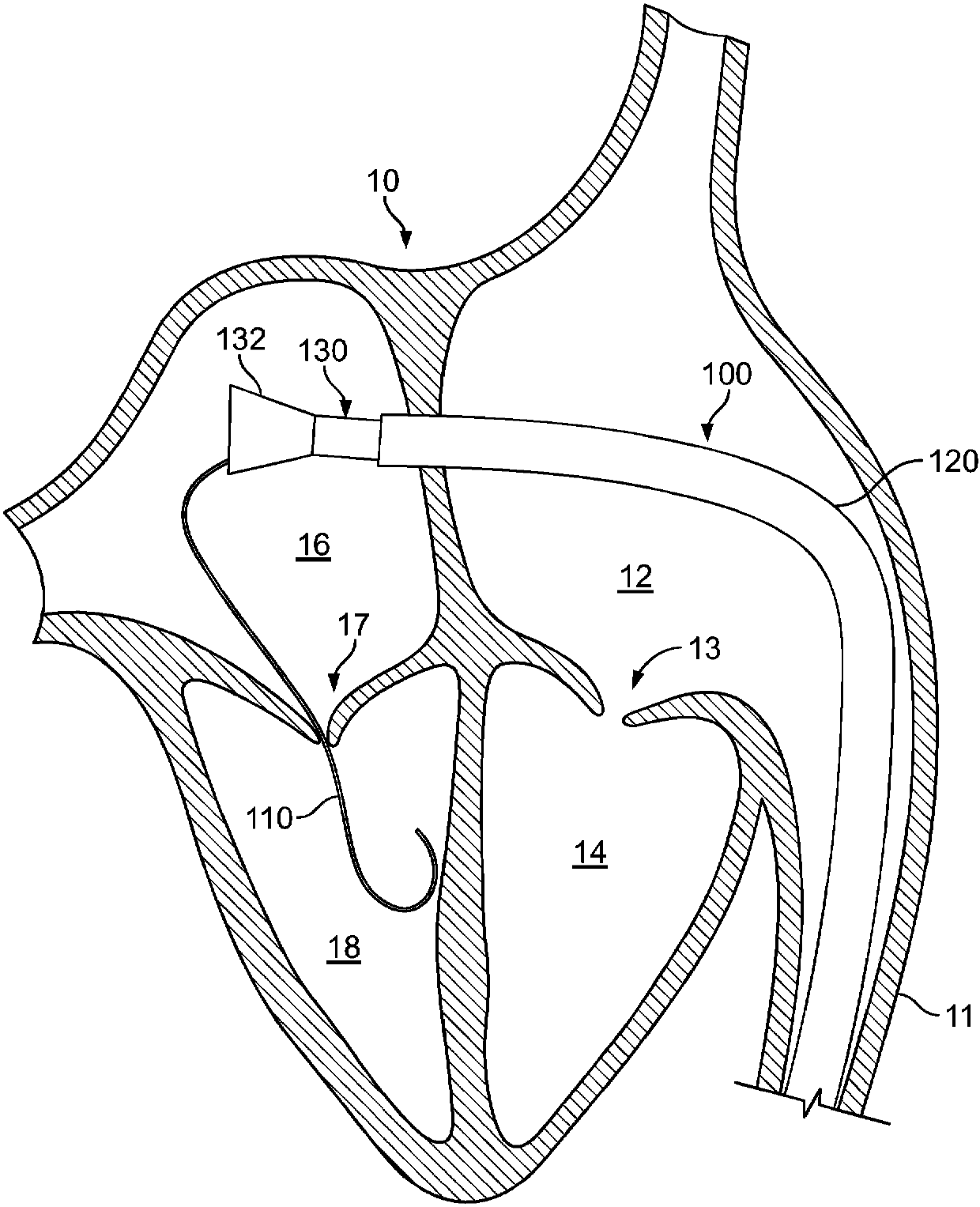 Systems and methods for heart valve therapy