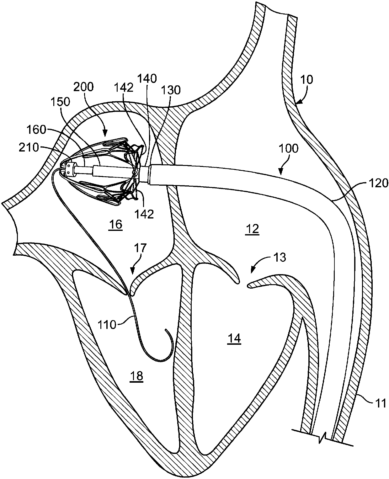 Systems and methods for heart valve therapy