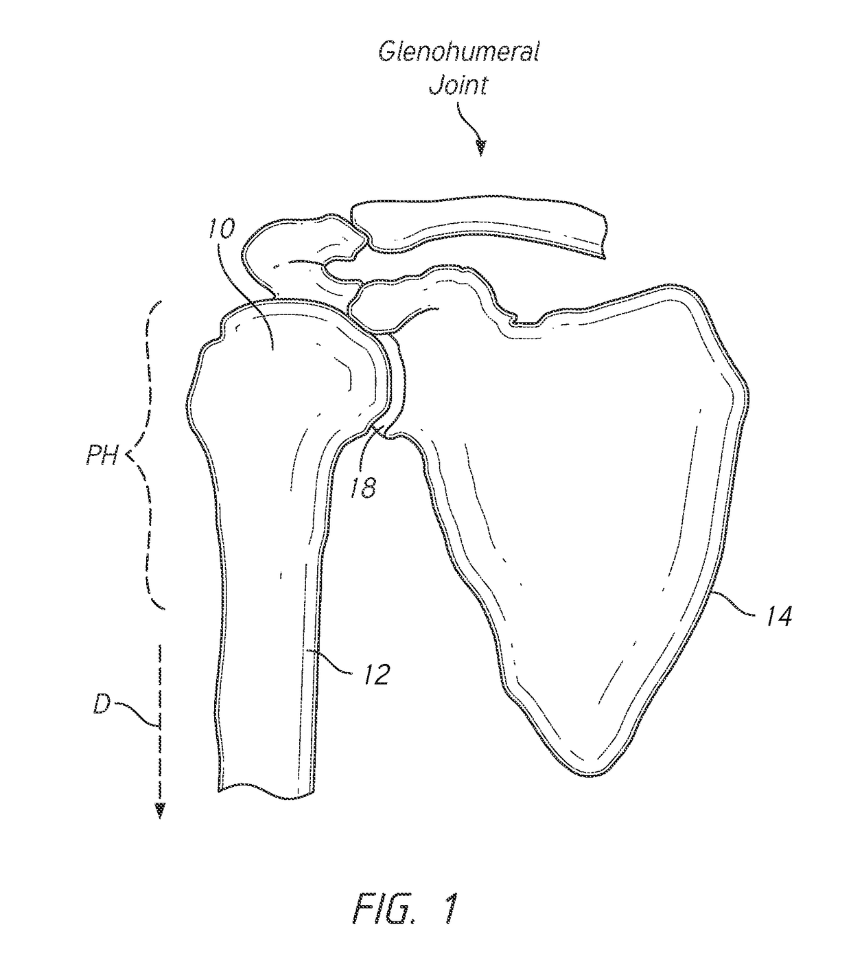 Patient specific humeral cutting guides