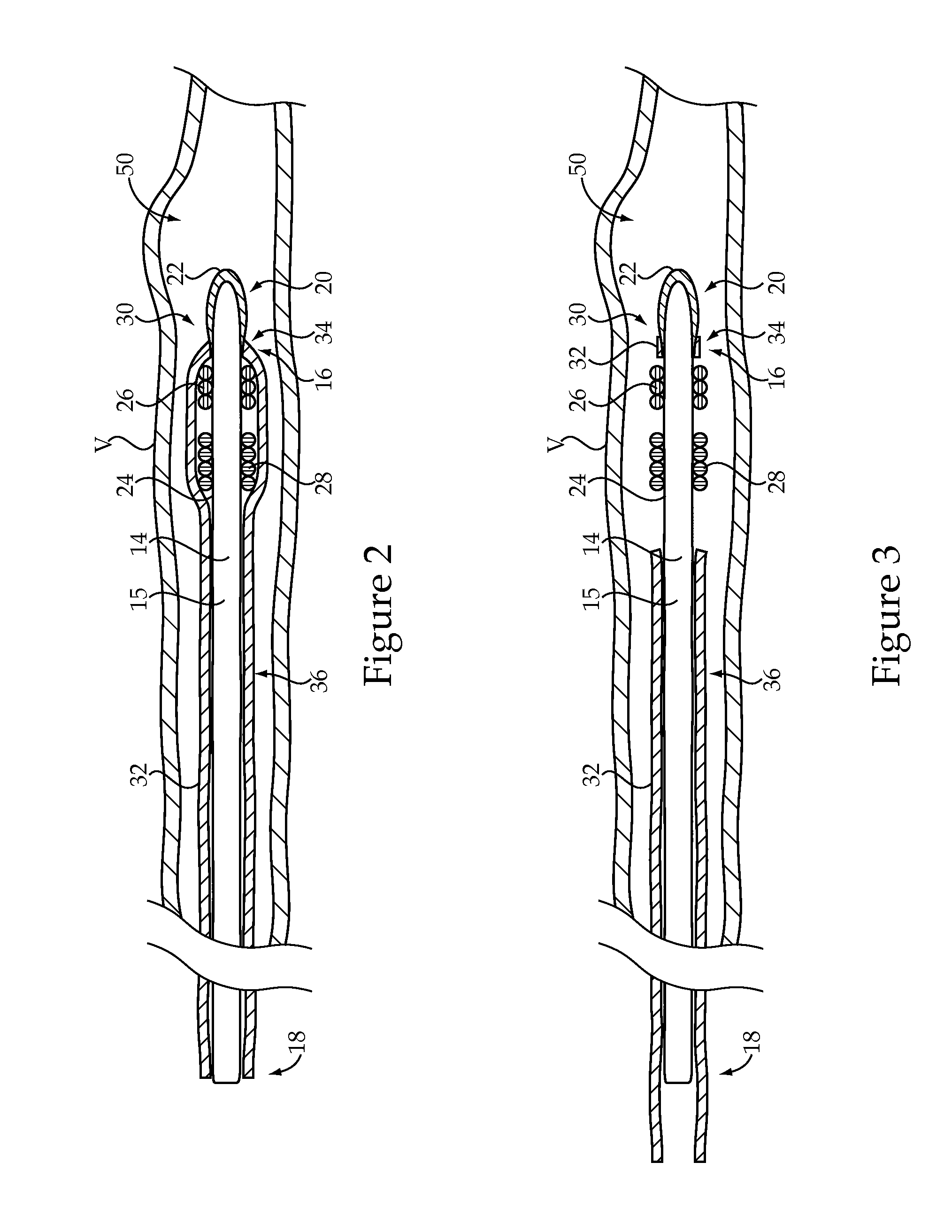 Embolic Coil Delivery System