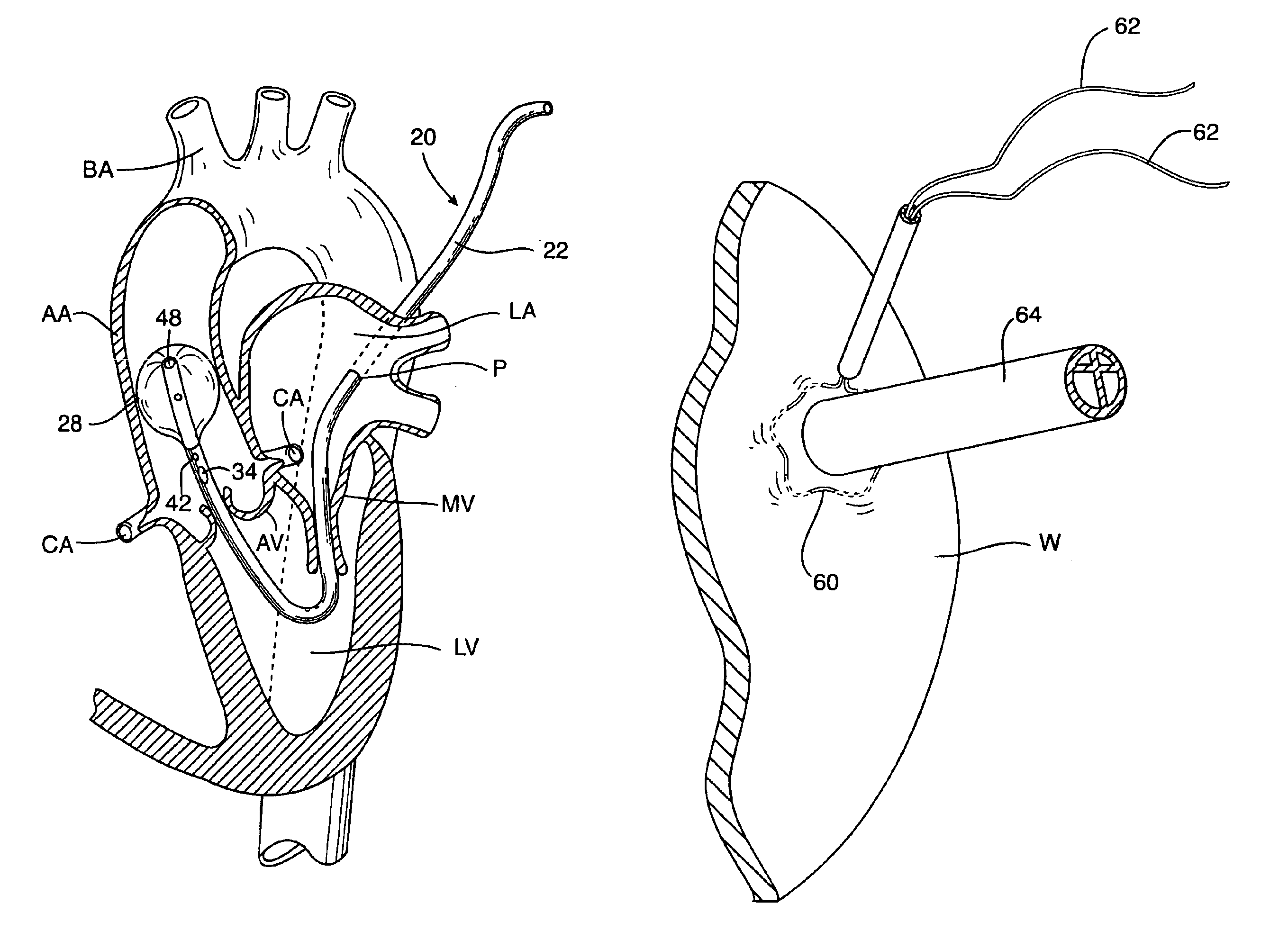 Antegrade cardioplegia catheter and method