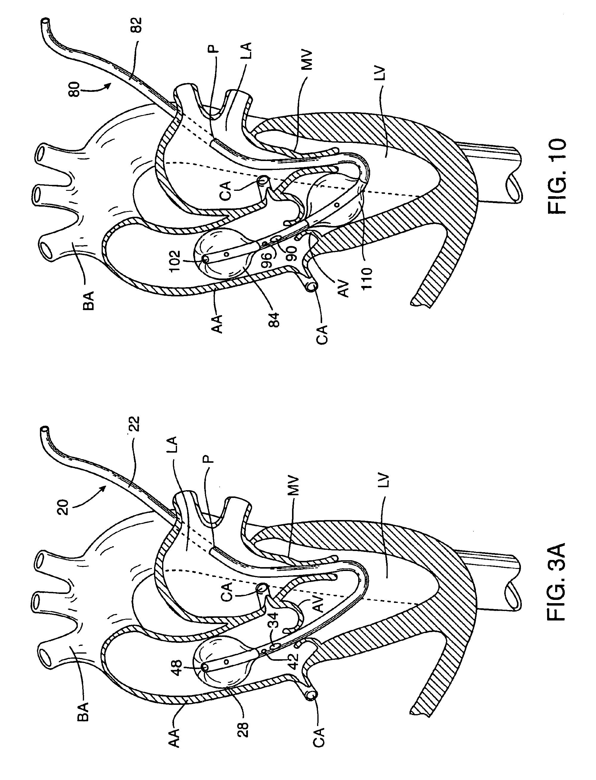 Antegrade cardioplegia catheter and method