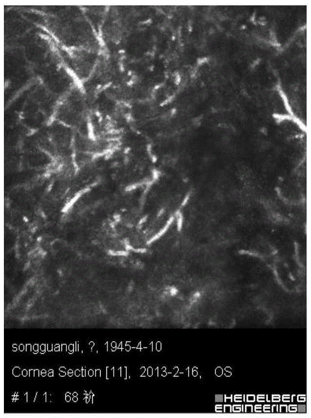 Image recognition method for fungal keratitis based on rx anomaly detection and texture analysis