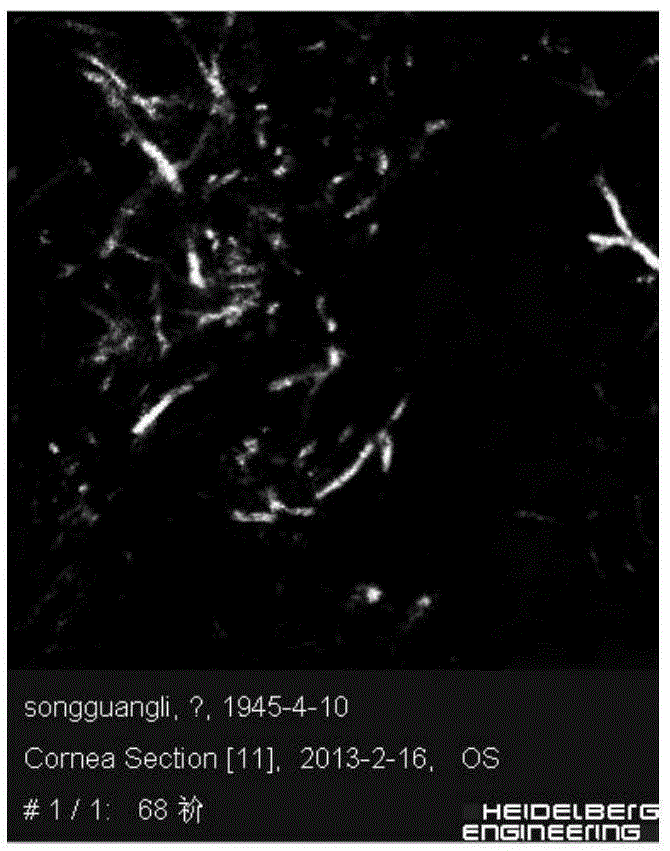 Image recognition method for fungal keratitis based on rx anomaly detection and texture analysis