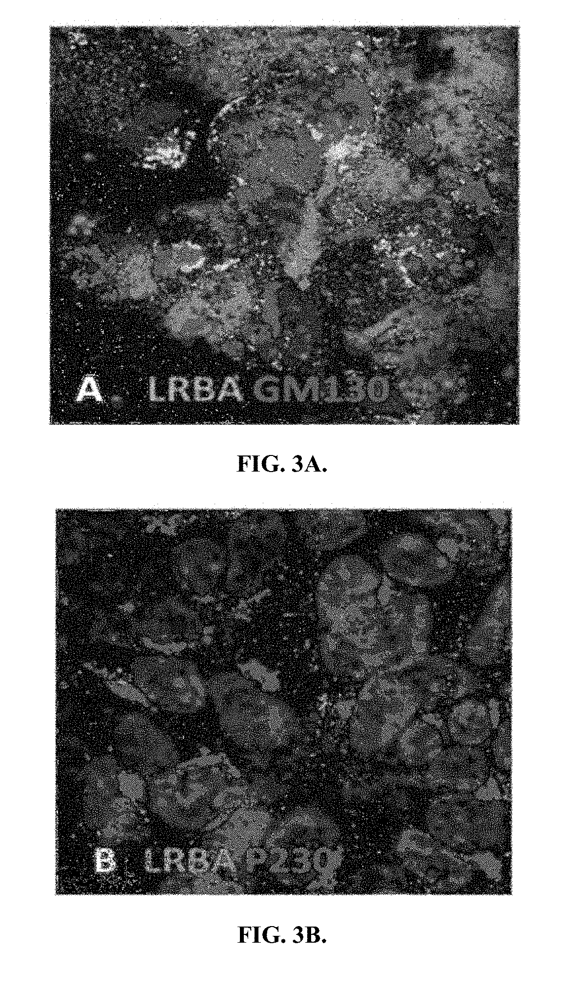 Inflammatory disease diagnosis and methods of treatment using lipopolysaccharides-responsive beige-like anchor