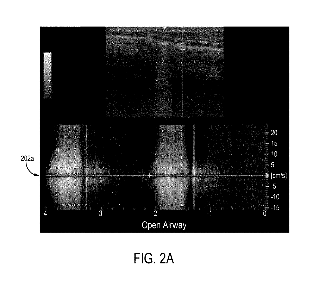 System and Method for Monitoring Airflow in a Subject's Airway with Ultrasound