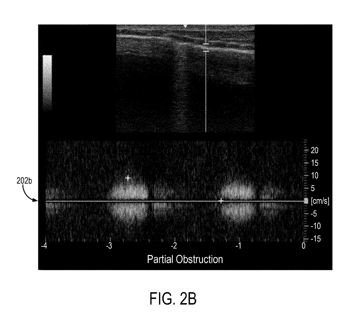 System and Method for Monitoring Airflow in a Subject's Airway with Ultrasound