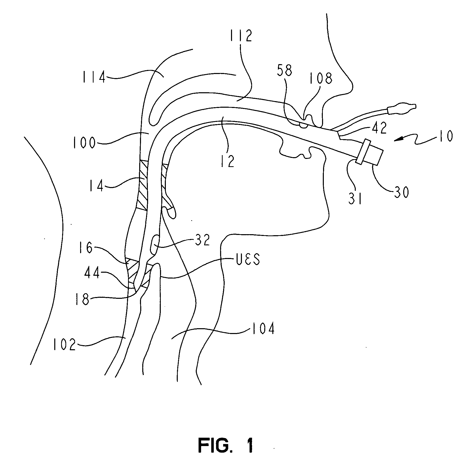 Non-tracheal ventilation tube