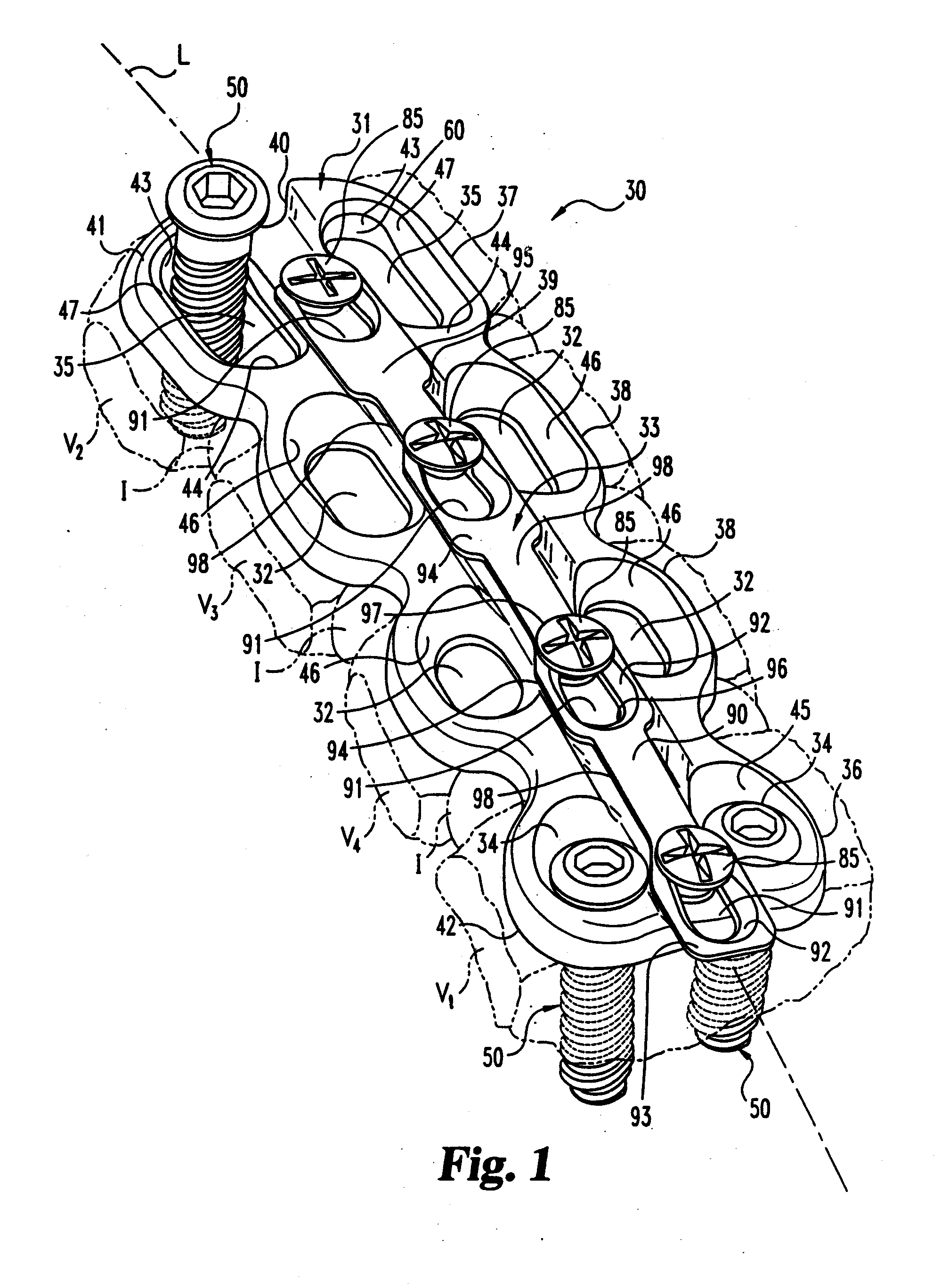 Anterior cervical plating system and method