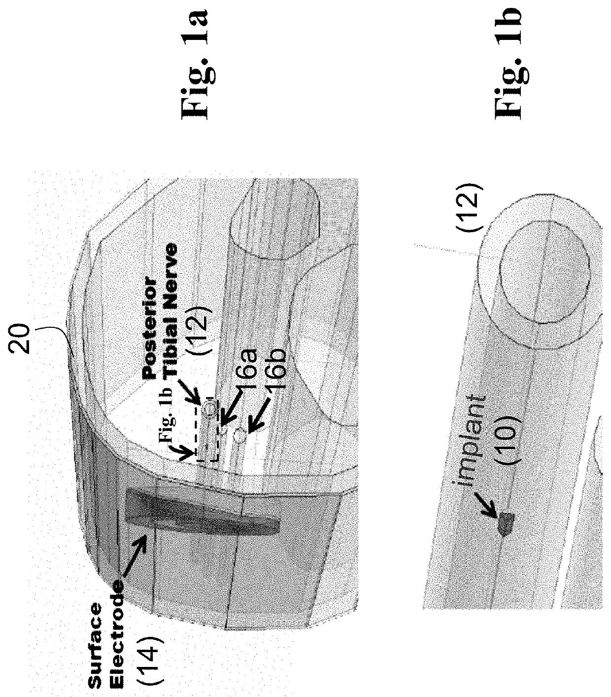 Systems and methods of enhancing electrical activation of nervous tissue