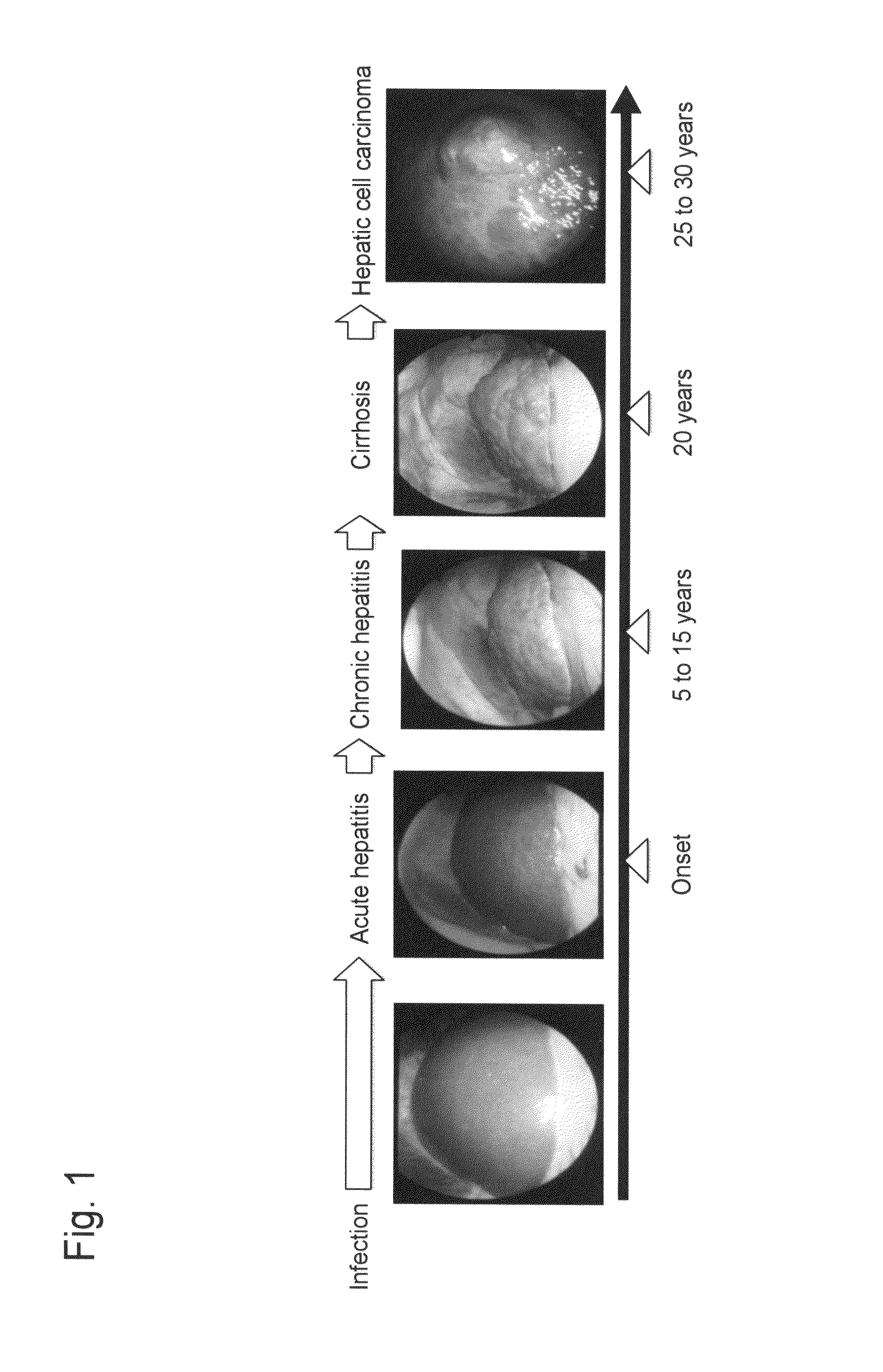 Method for measuring glycoprotein, method for examining liver disease, reagent for quantitative determination of glycoprotein, and glycan-marker glycoprotein as an index for clinical conditions of liver disease