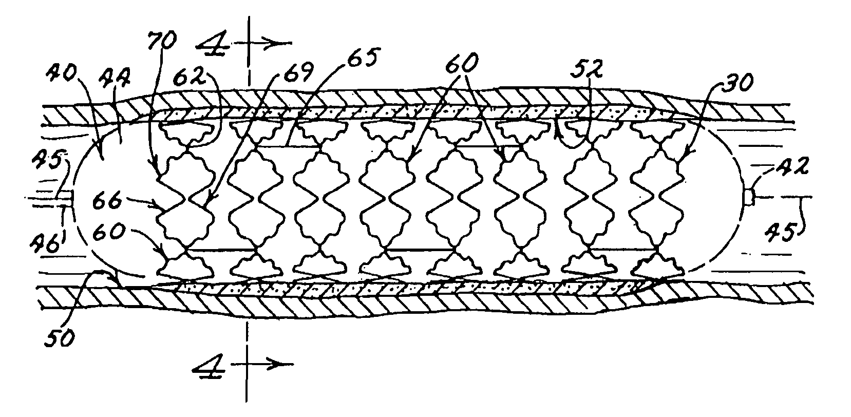 Expandable stent having a plurality of interconnected expansion modules