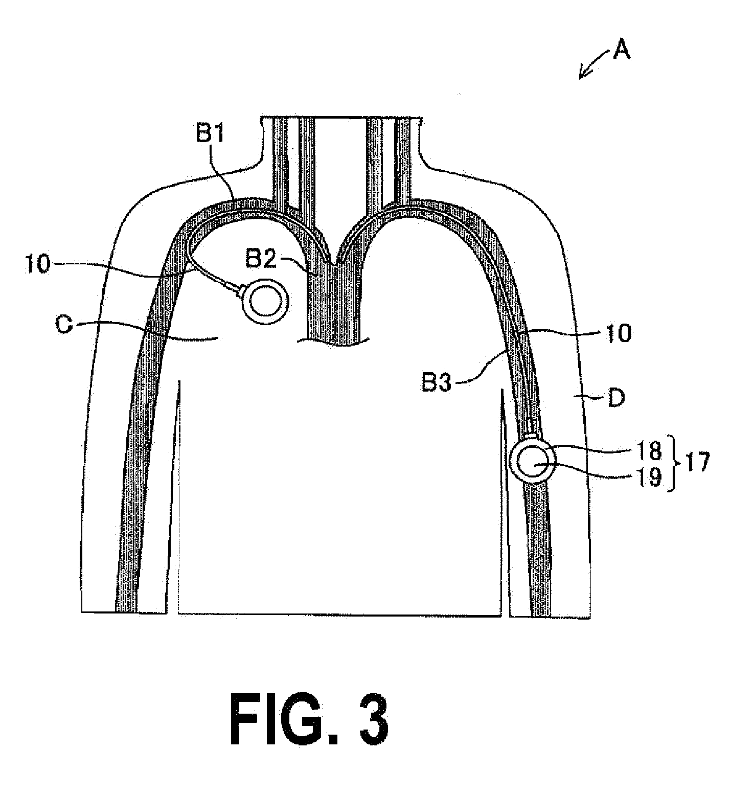 Valved catheter