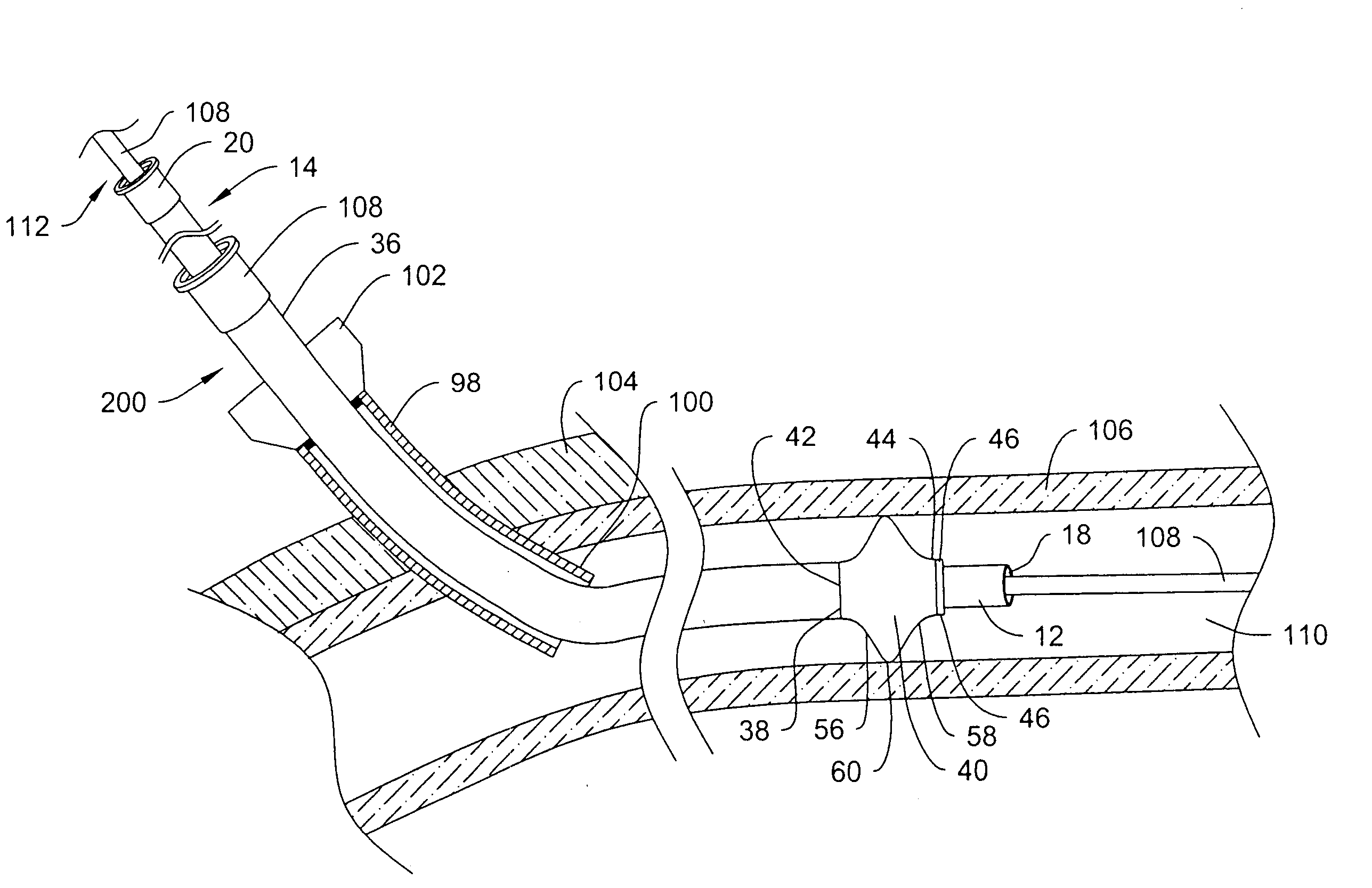 Catheter with distal occlusion