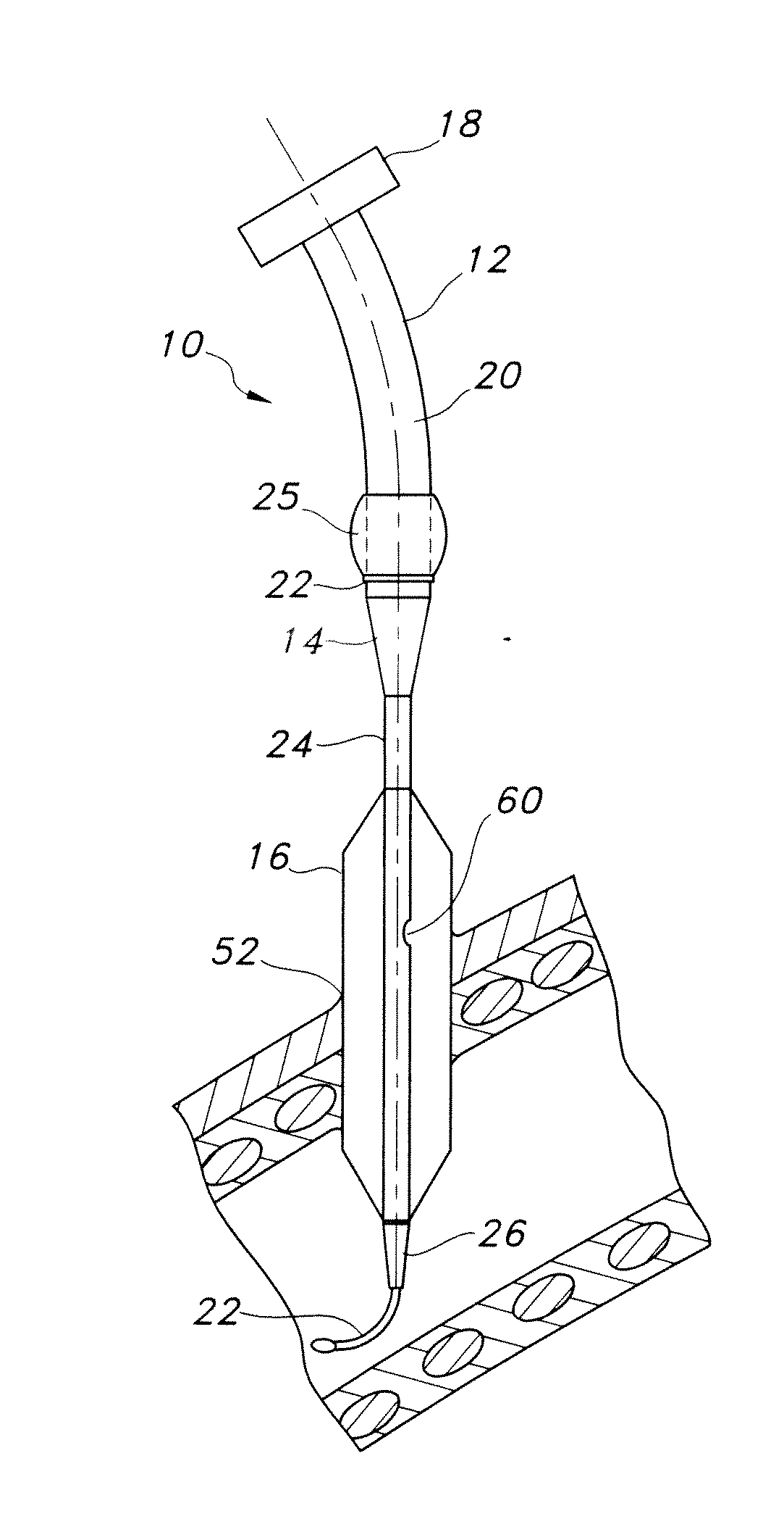 Internally Braced Radial Balloon Dilator