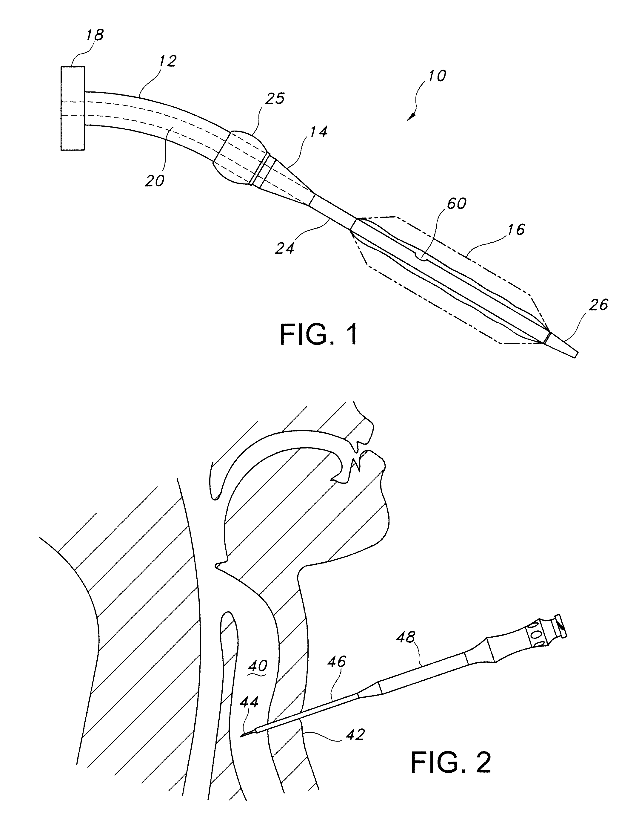 Internally Braced Radial Balloon Dilator