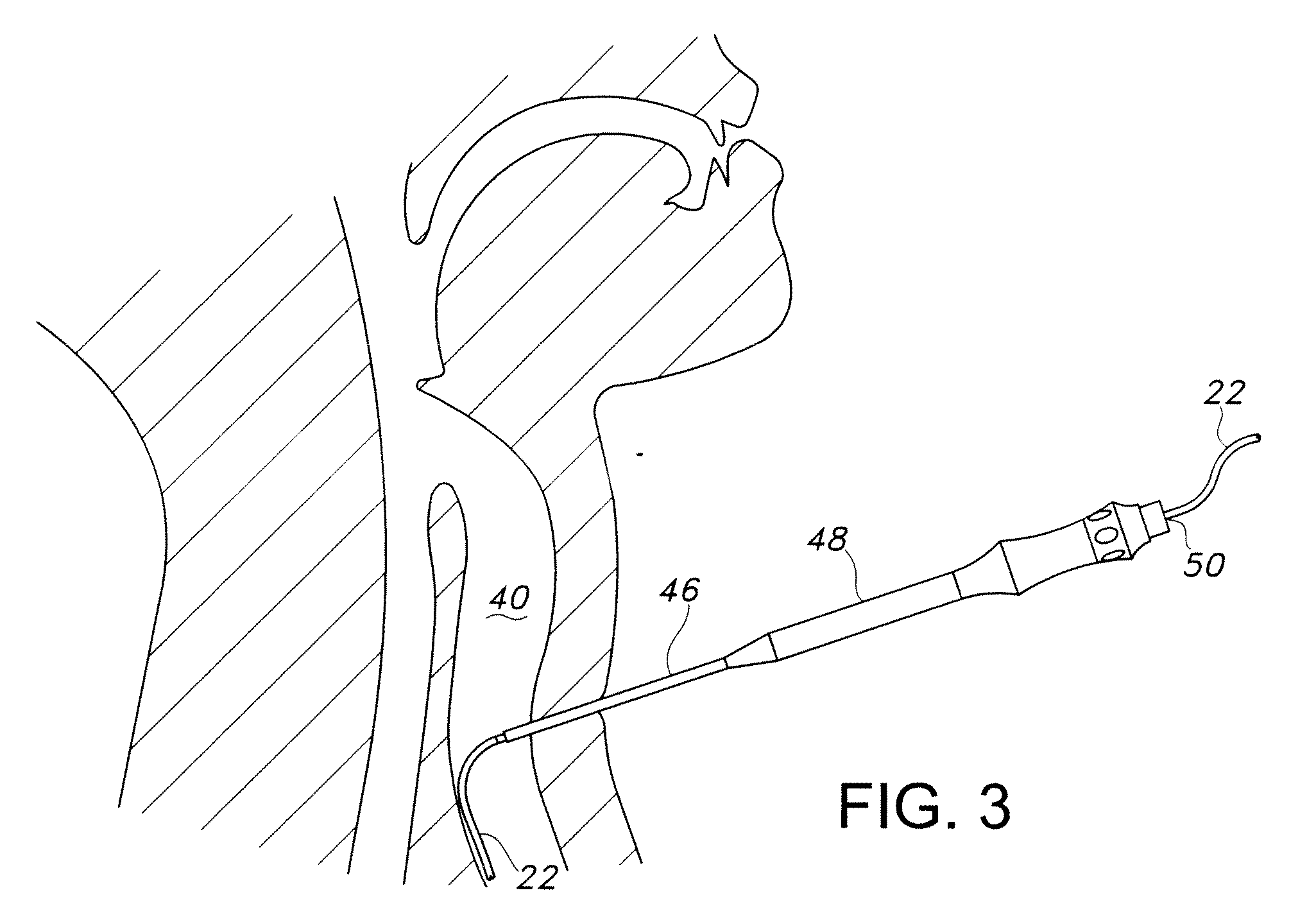 Internally Braced Radial Balloon Dilator