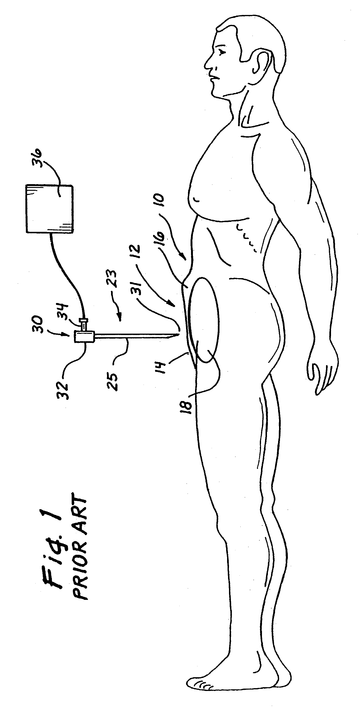 Surgical access apparatus and method