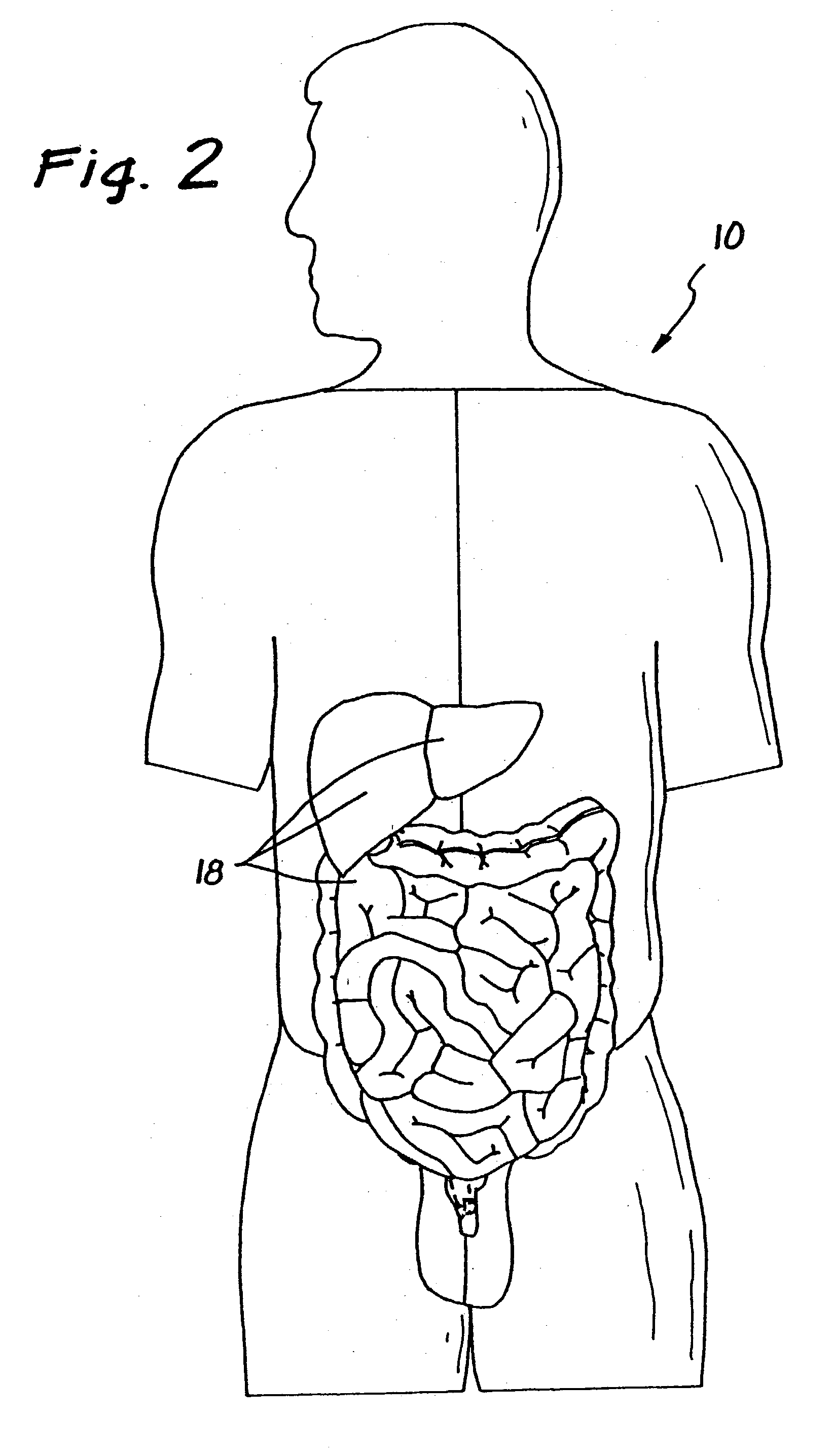 Surgical access apparatus and method