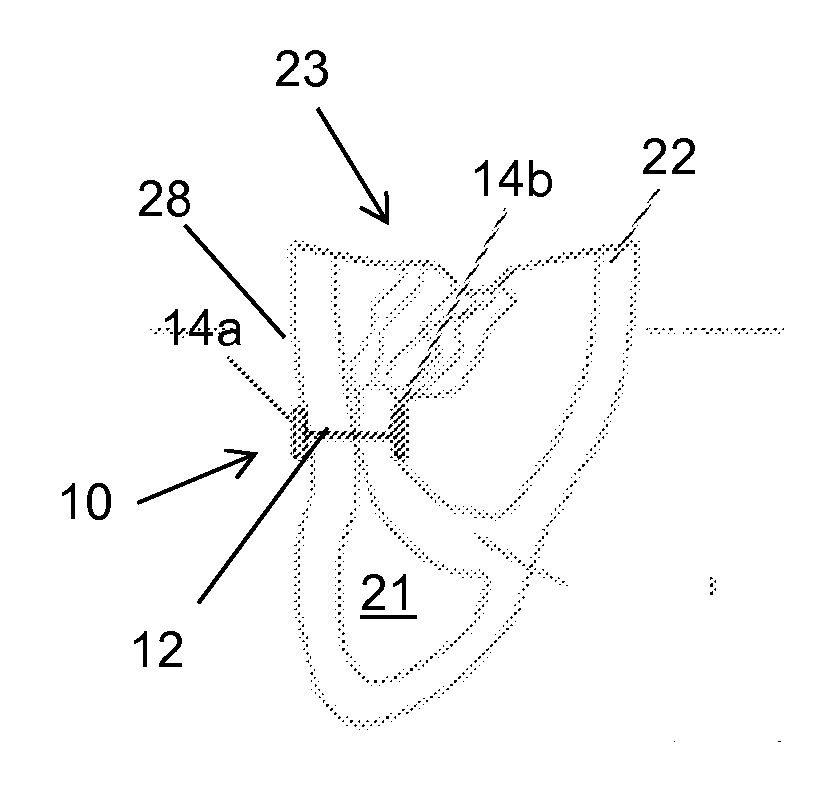 Right ventricular papillary approximation