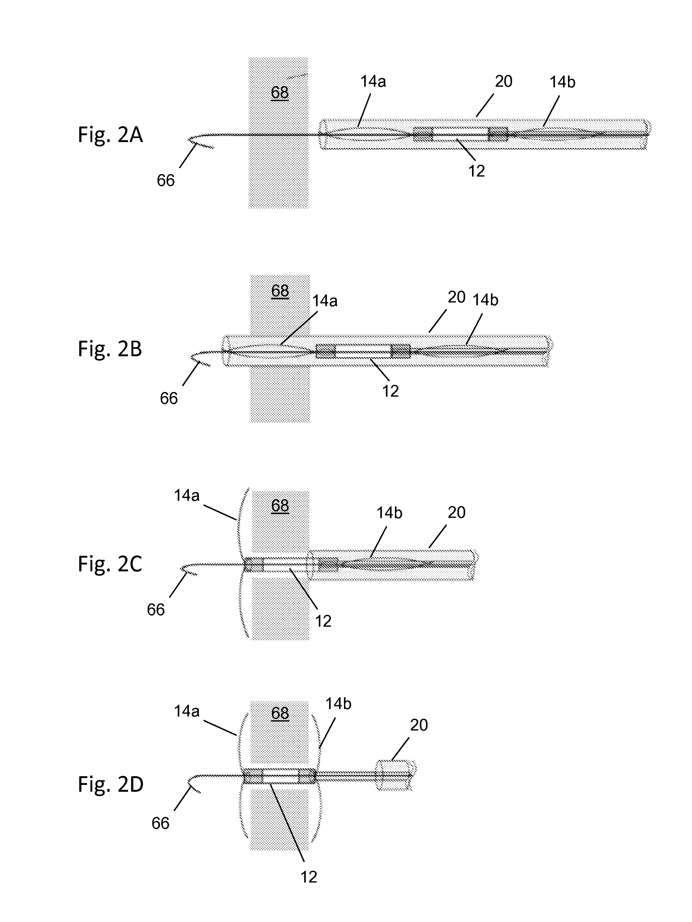 Right ventricular papillary approximation