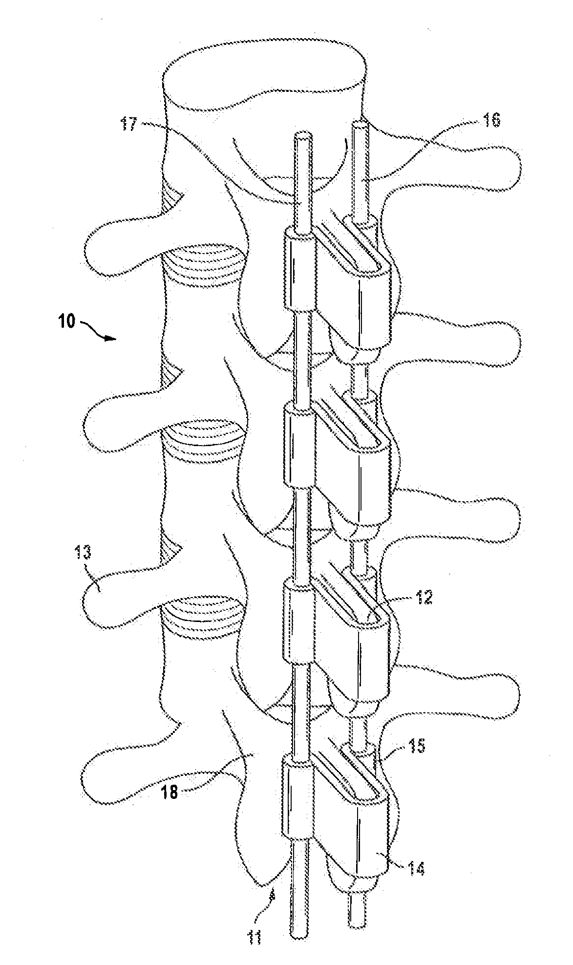 Orthosis to Correct Spinal Deformities