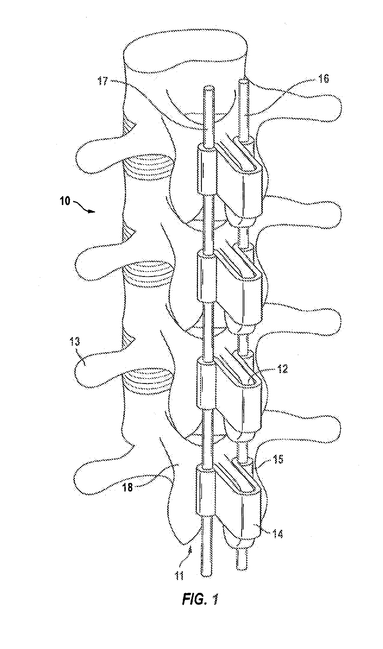 Orthosis to Correct Spinal Deformities