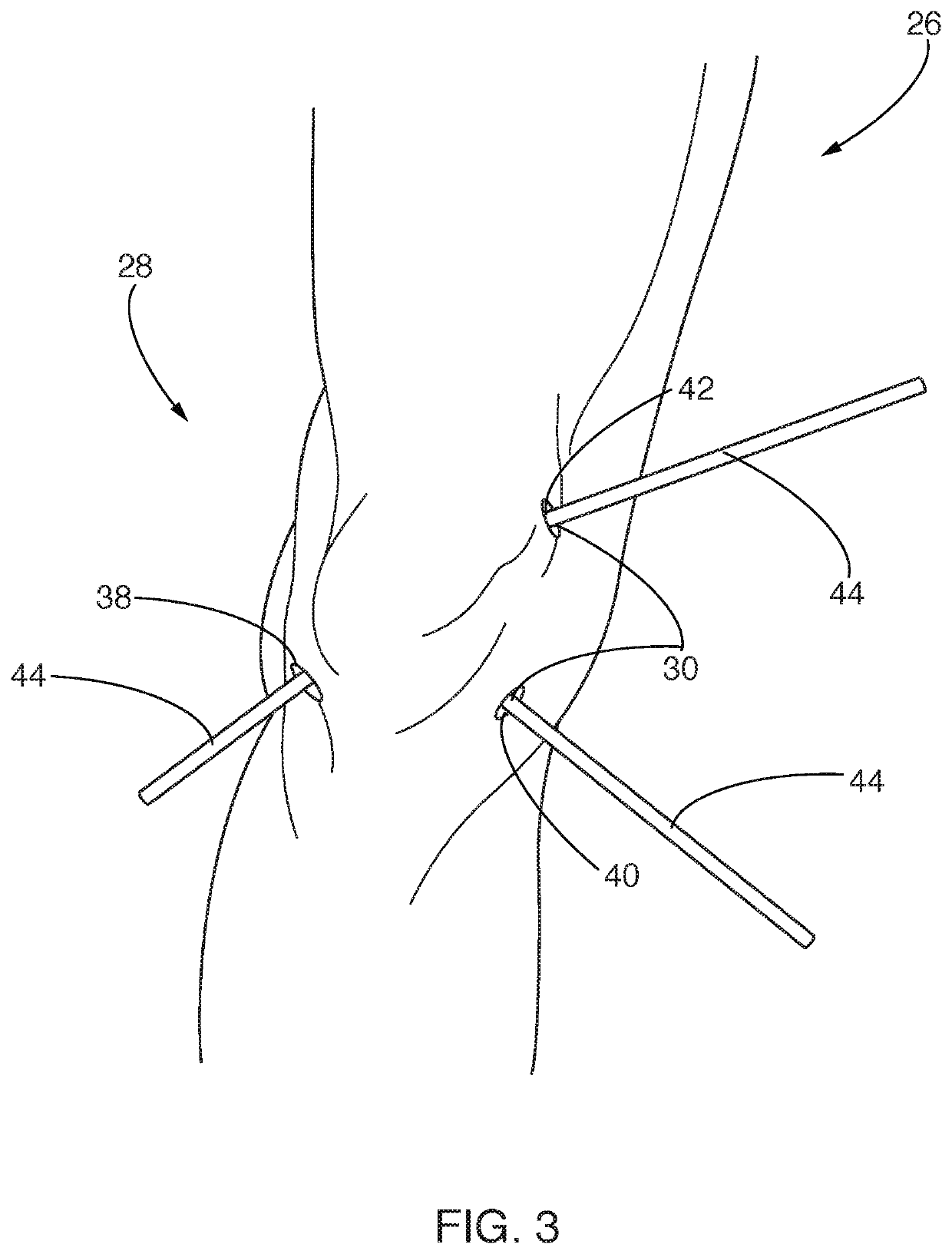 Systems and methods for reducing contaminants in a portion of a patient