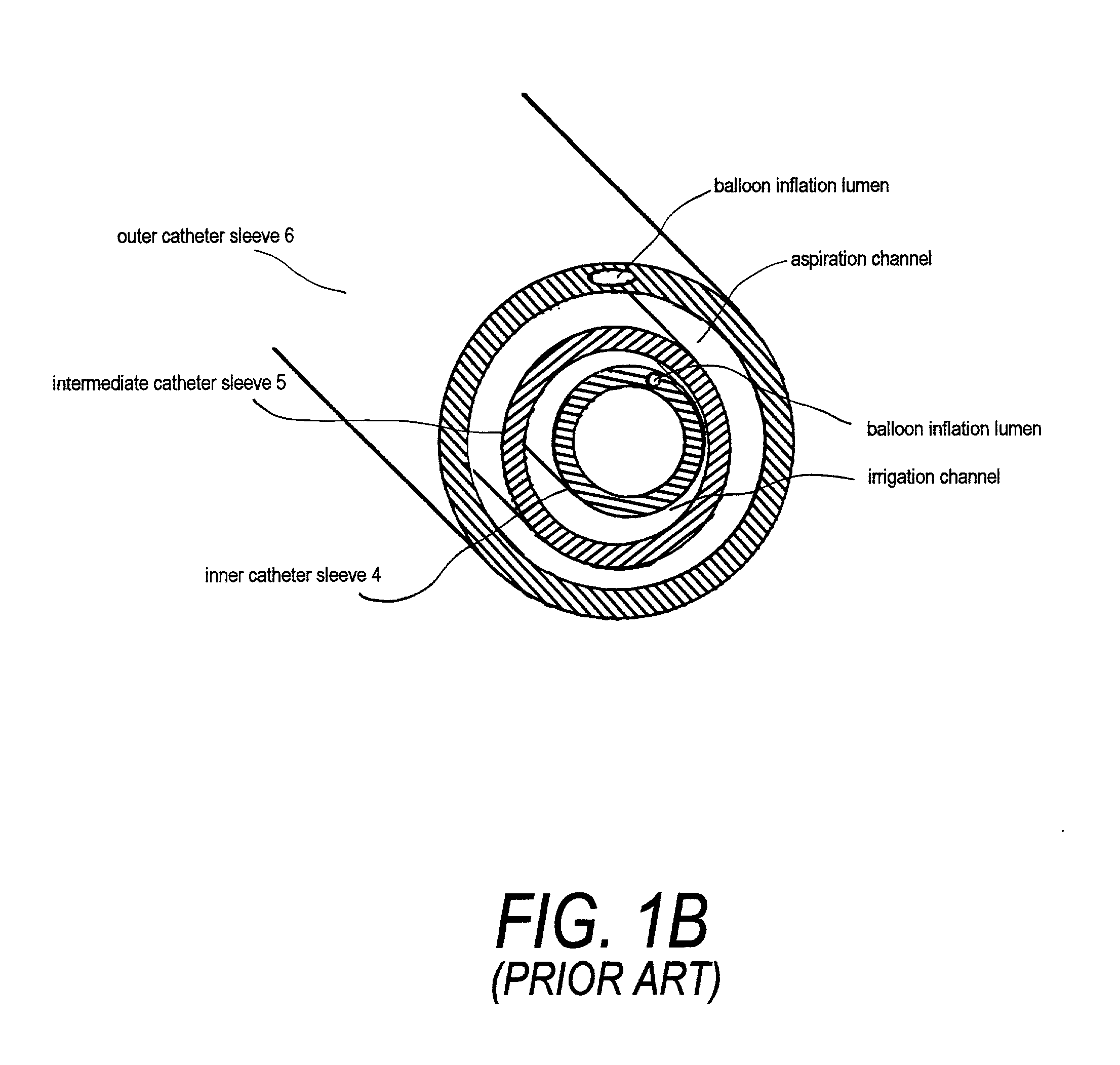 Electrical discharge catheter system for extracting emboli in endovascular interventions