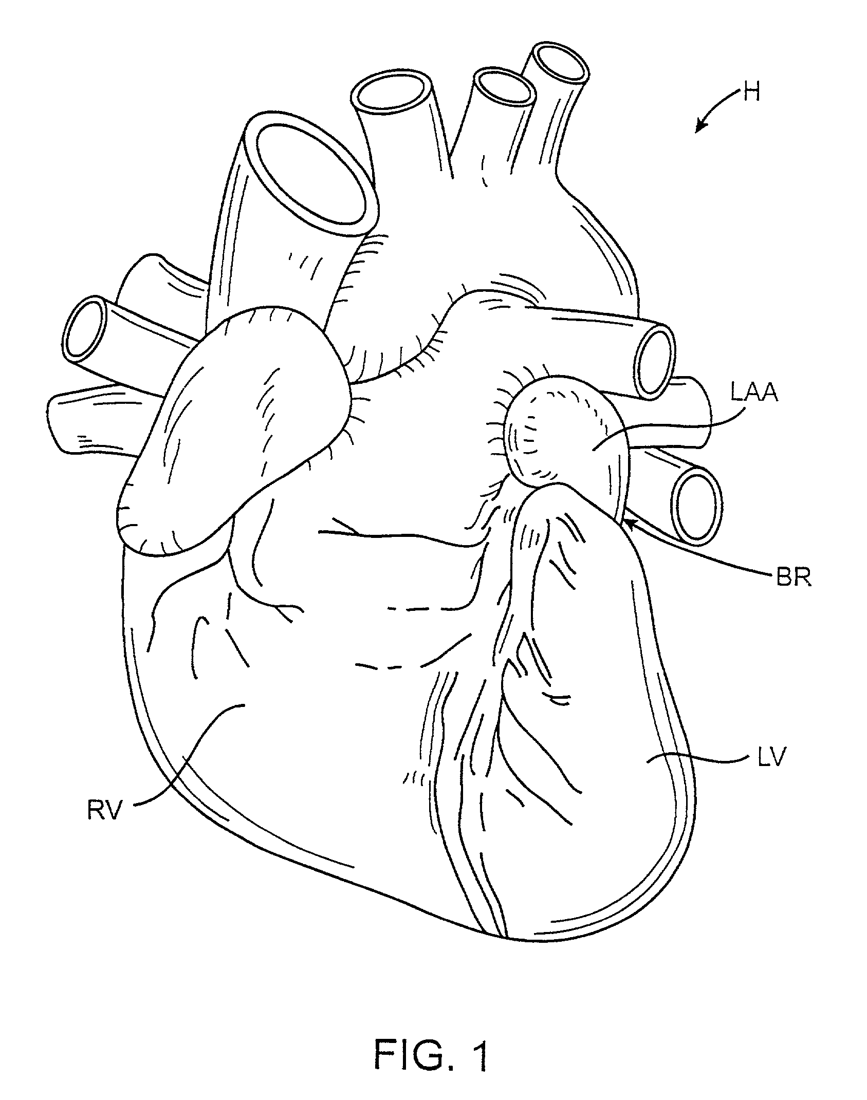 Methods and apparatus for transpericardial left atrial appendage closure