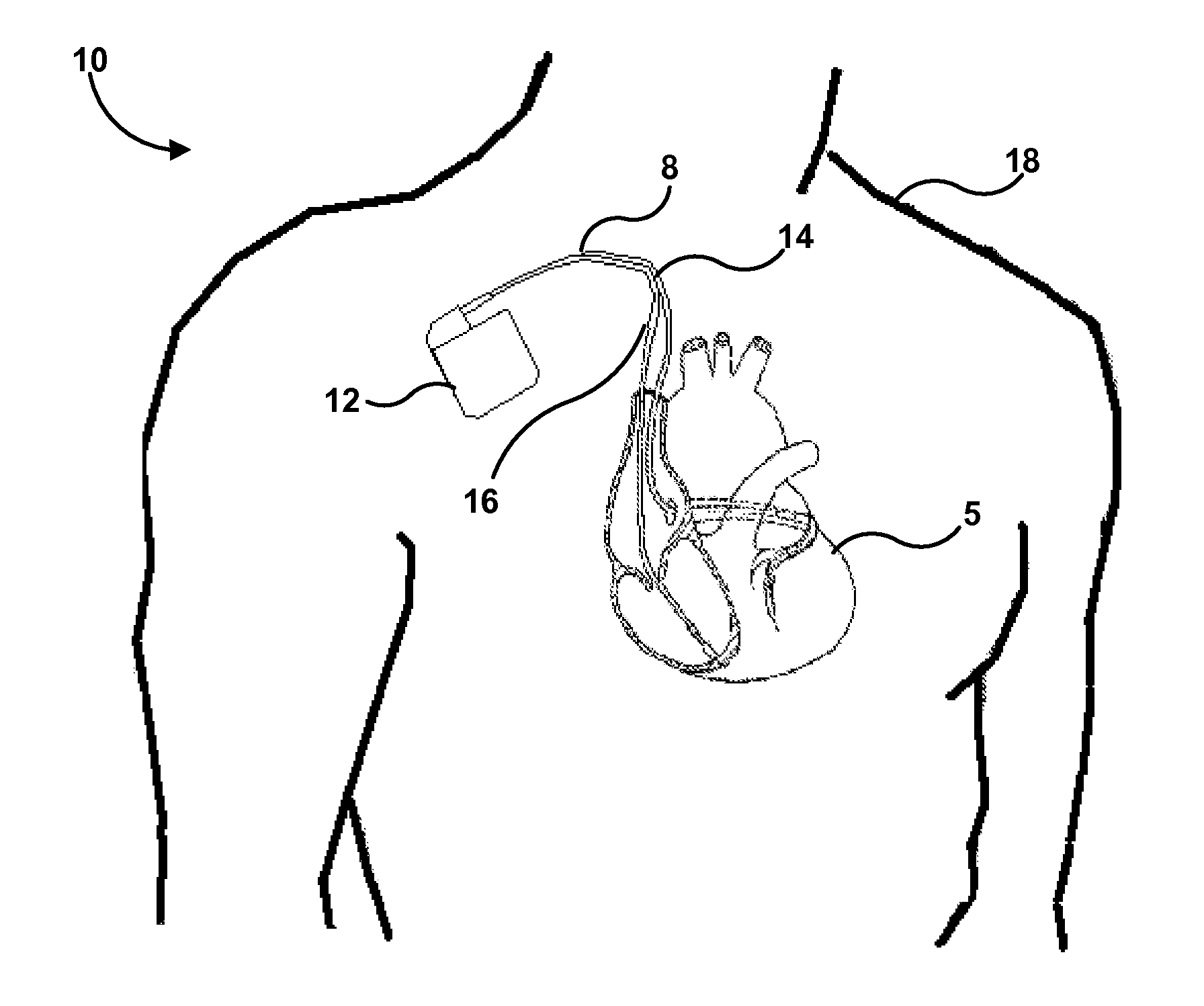 Implantable medical lead with biased electrode