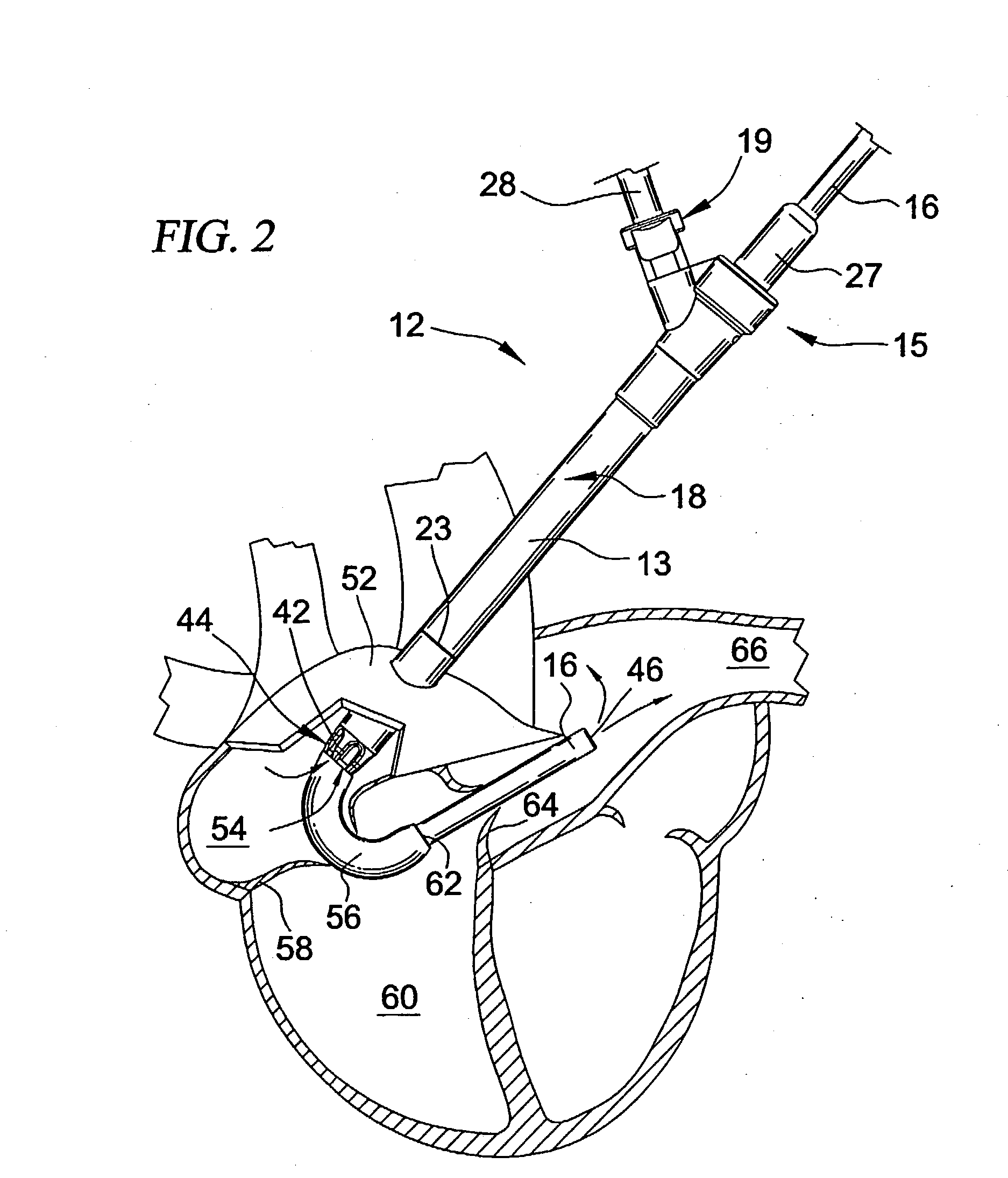 Cannulation system and related methods
