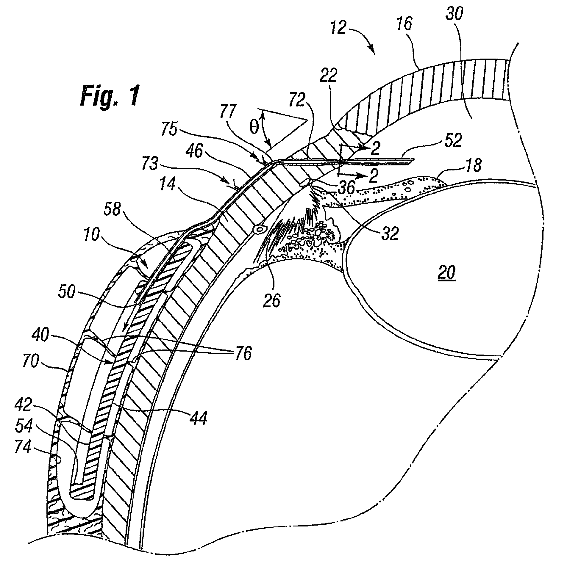 Glaucoma drainage shunts and methods of use