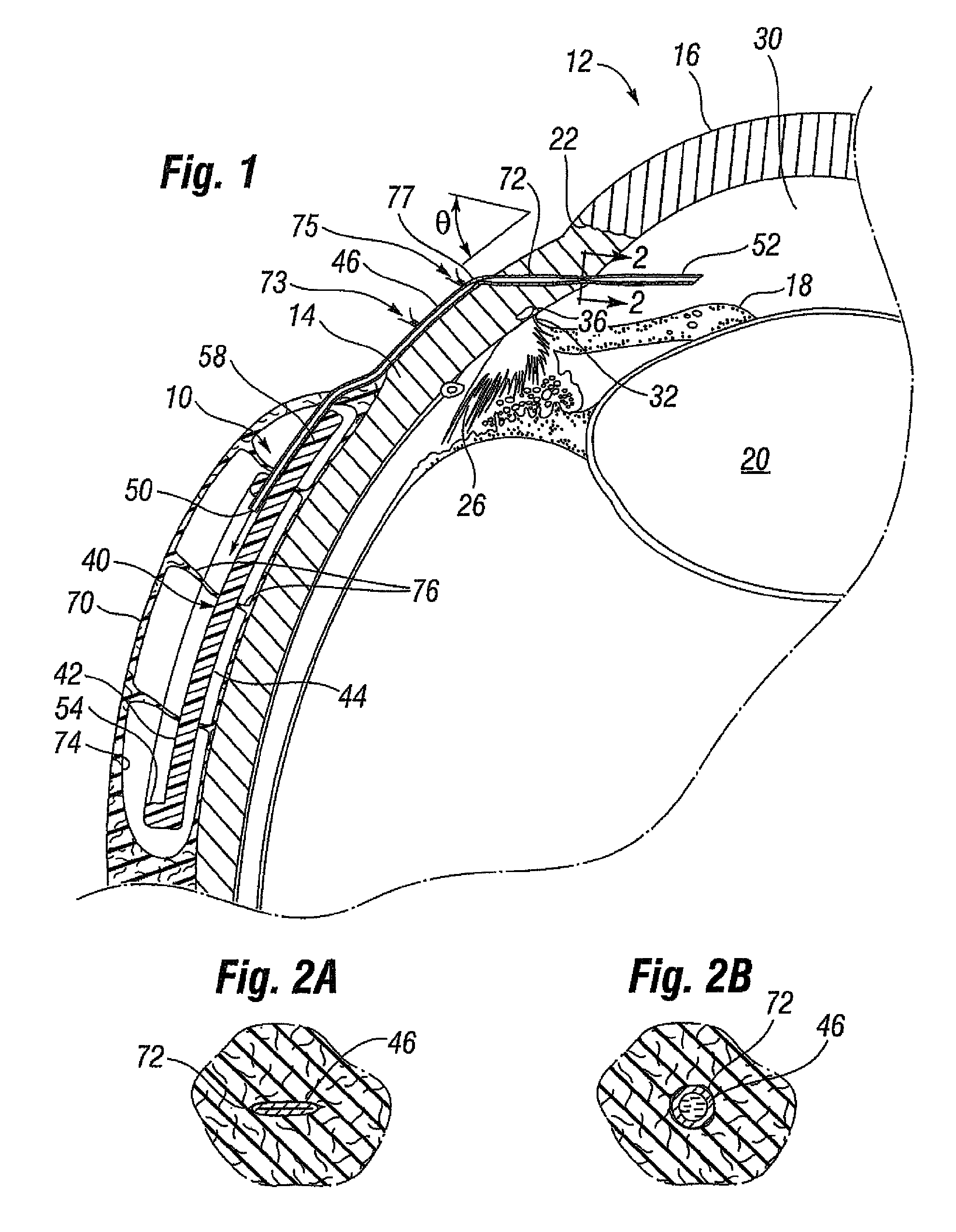 Glaucoma drainage shunts and methods of use